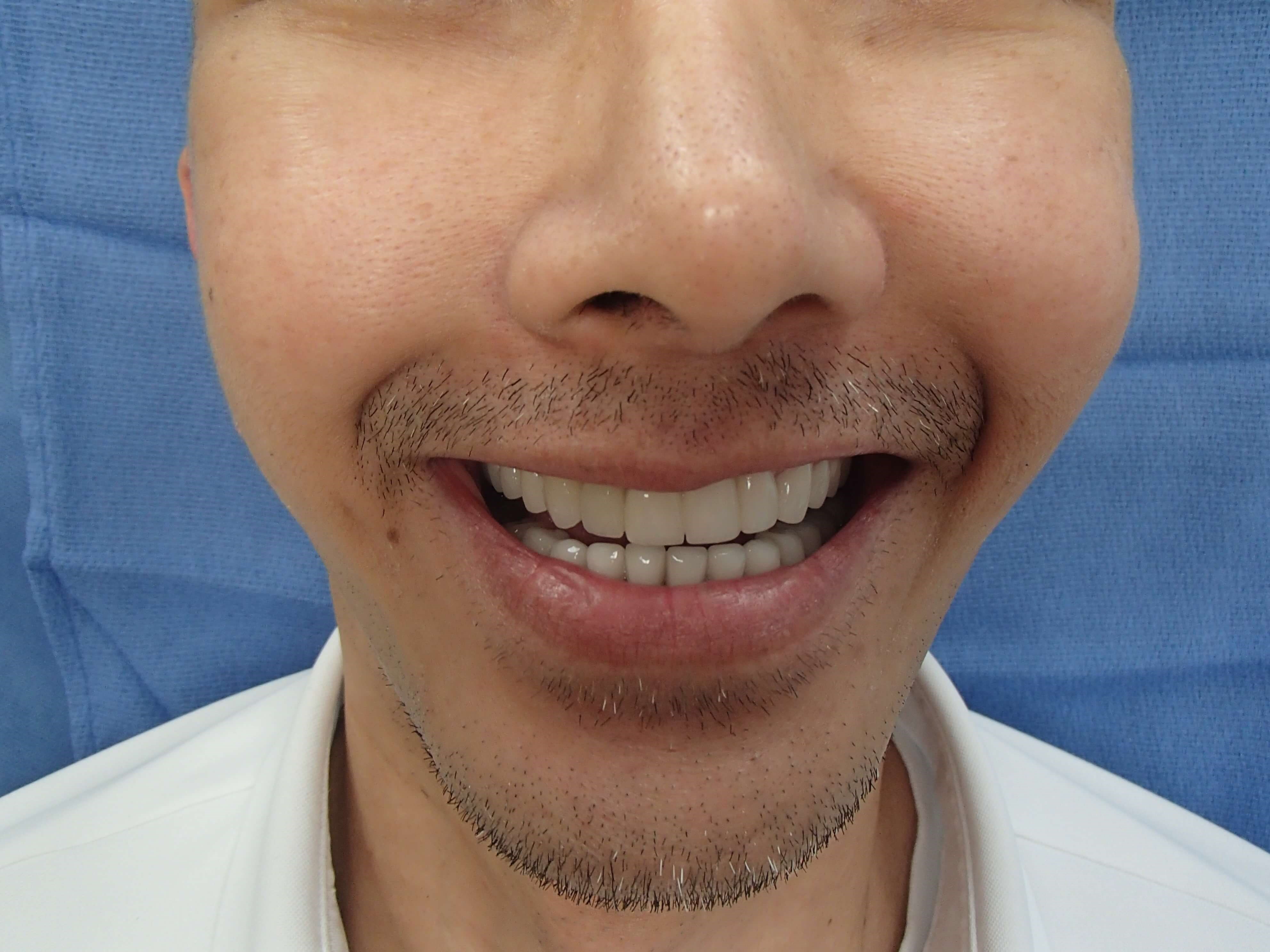 Timeless Dimples Before