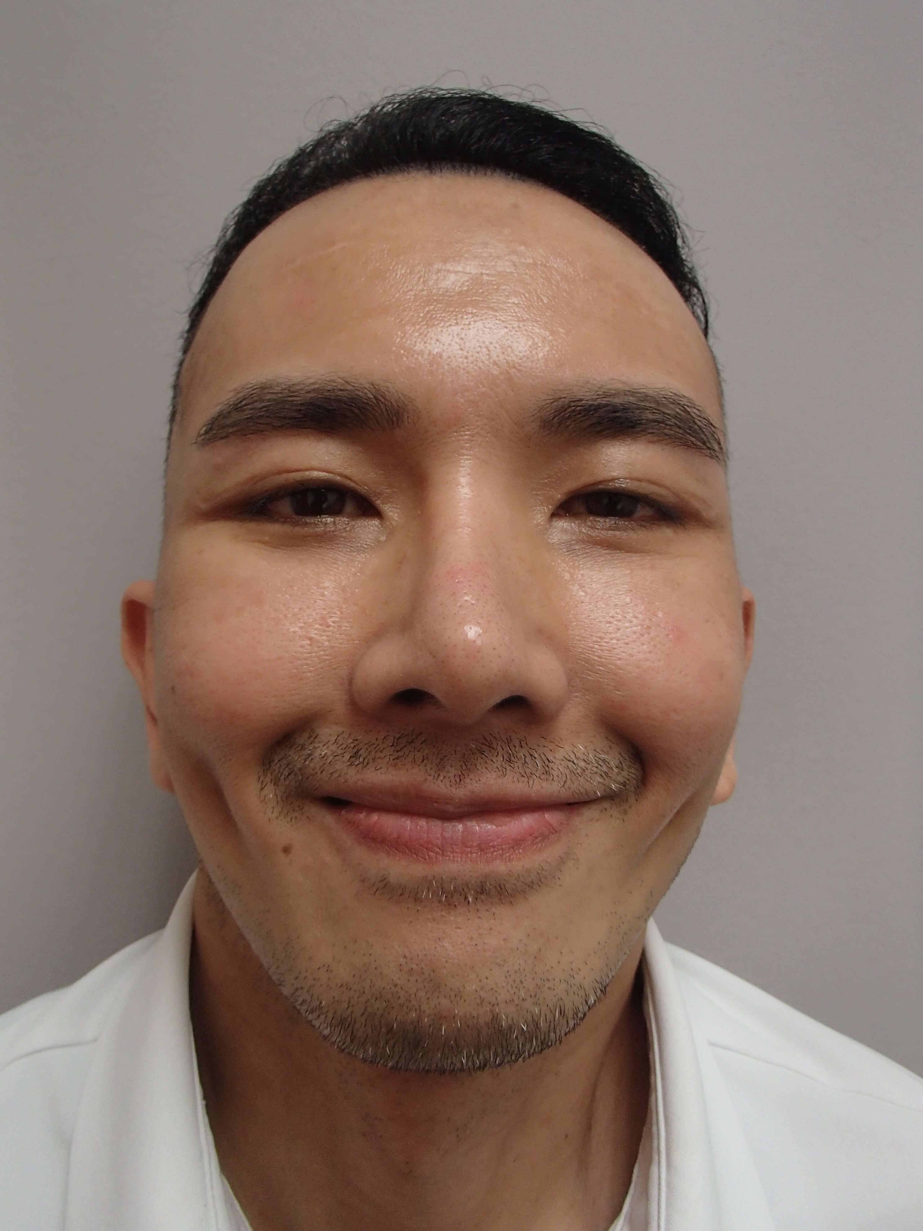 Timeless Dimples After