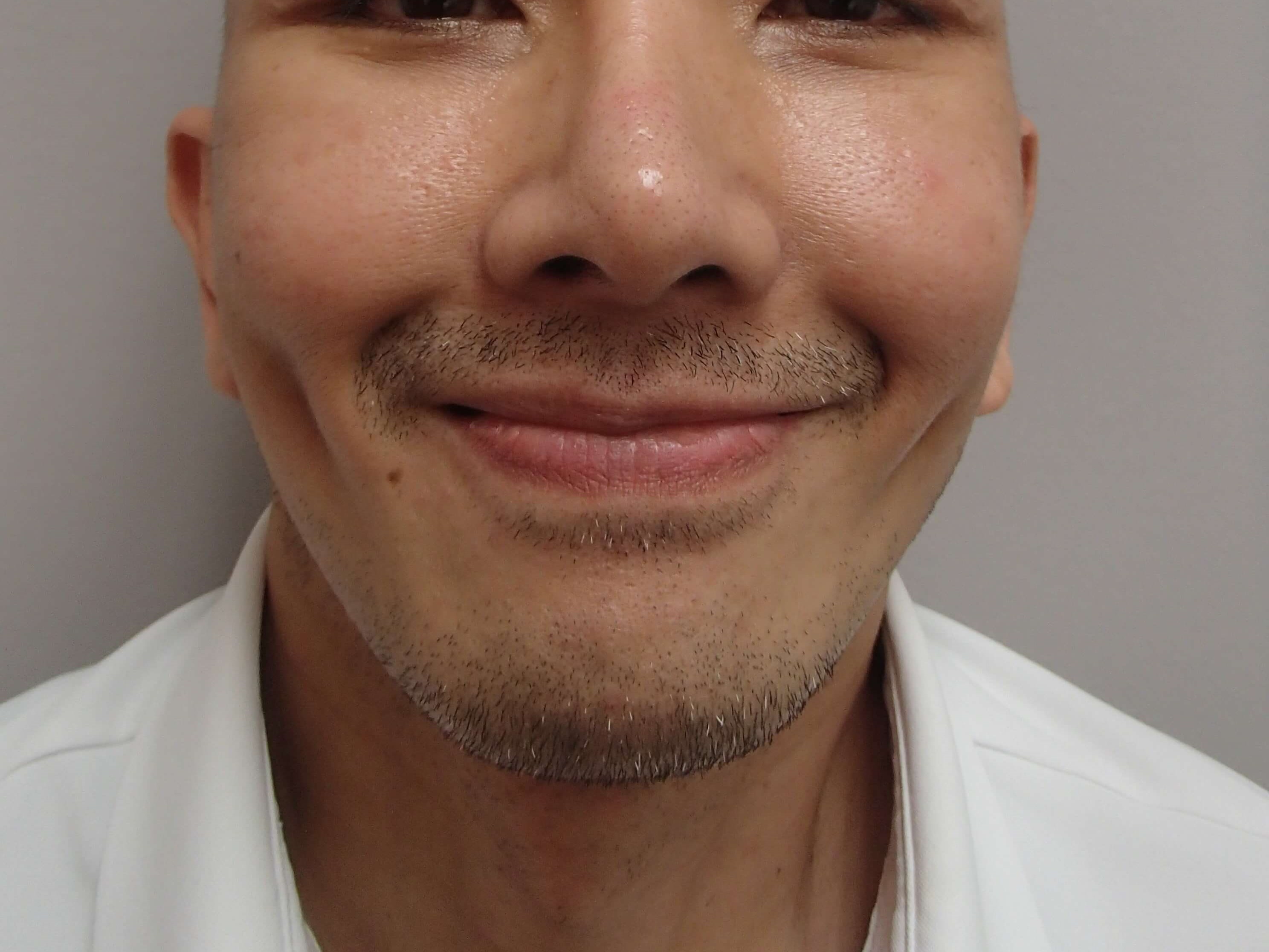 Timeless Dimples After
