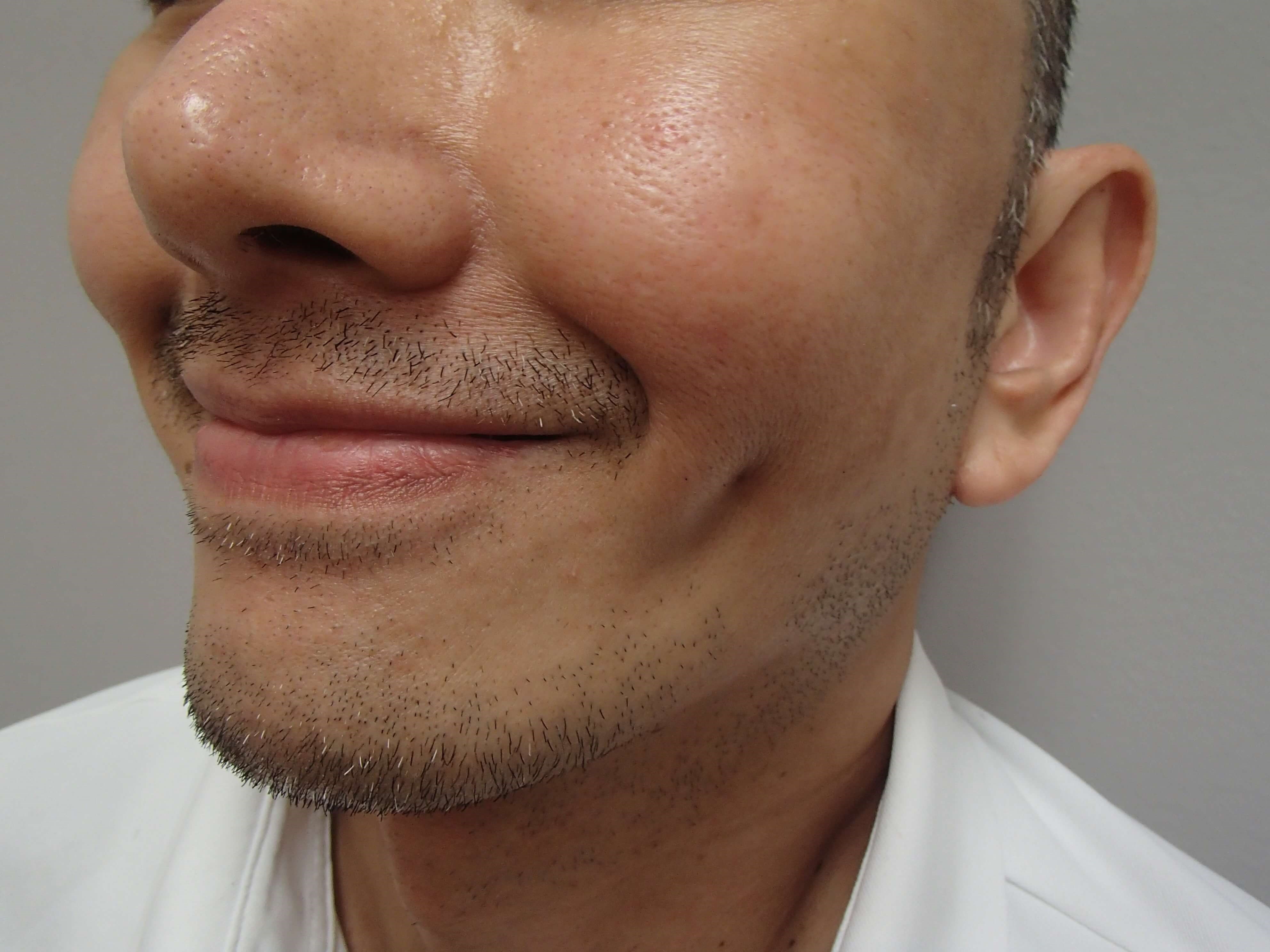 Timeless Dimples After