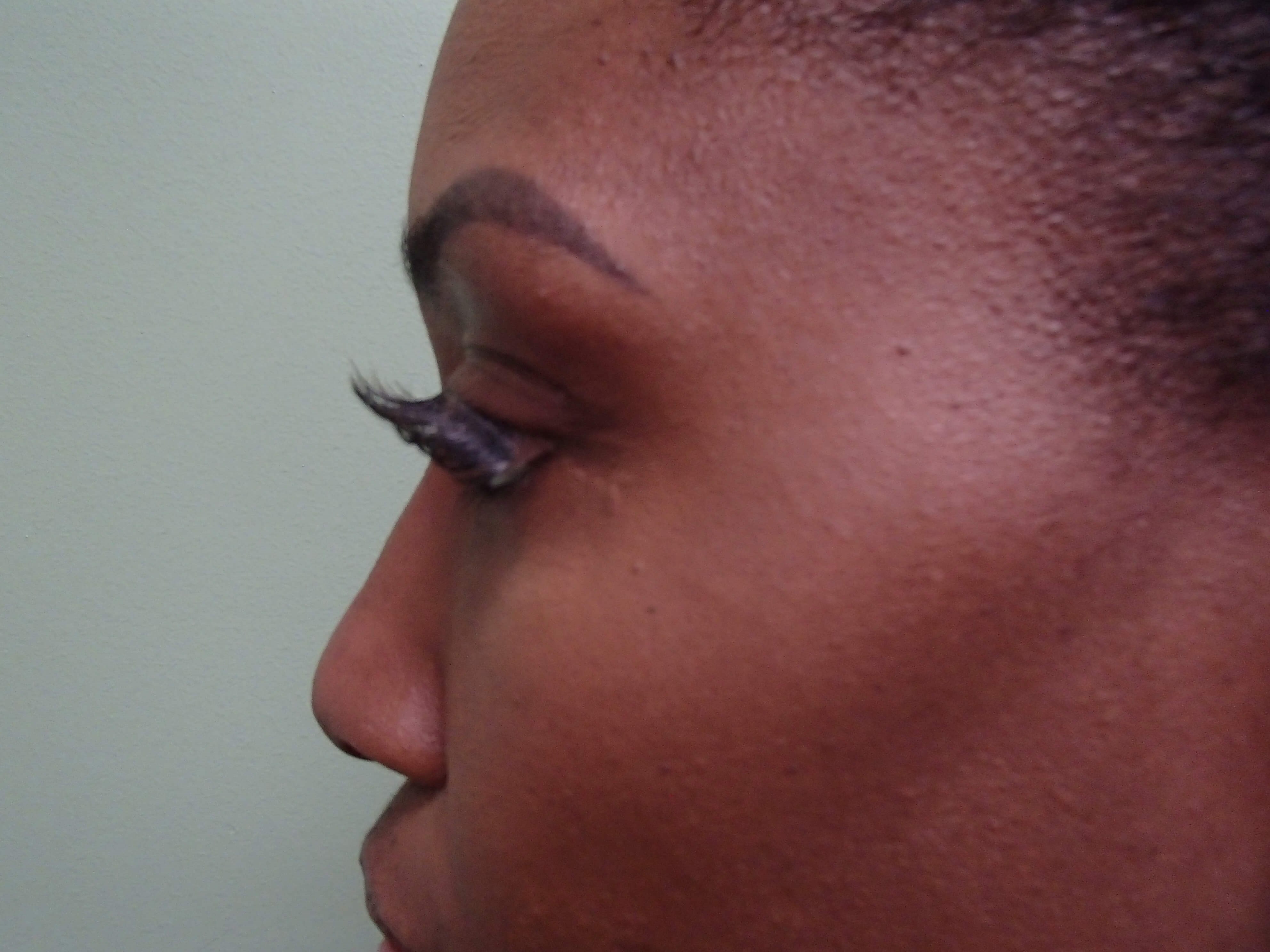 Rhinoplasty (Nose Job) Before