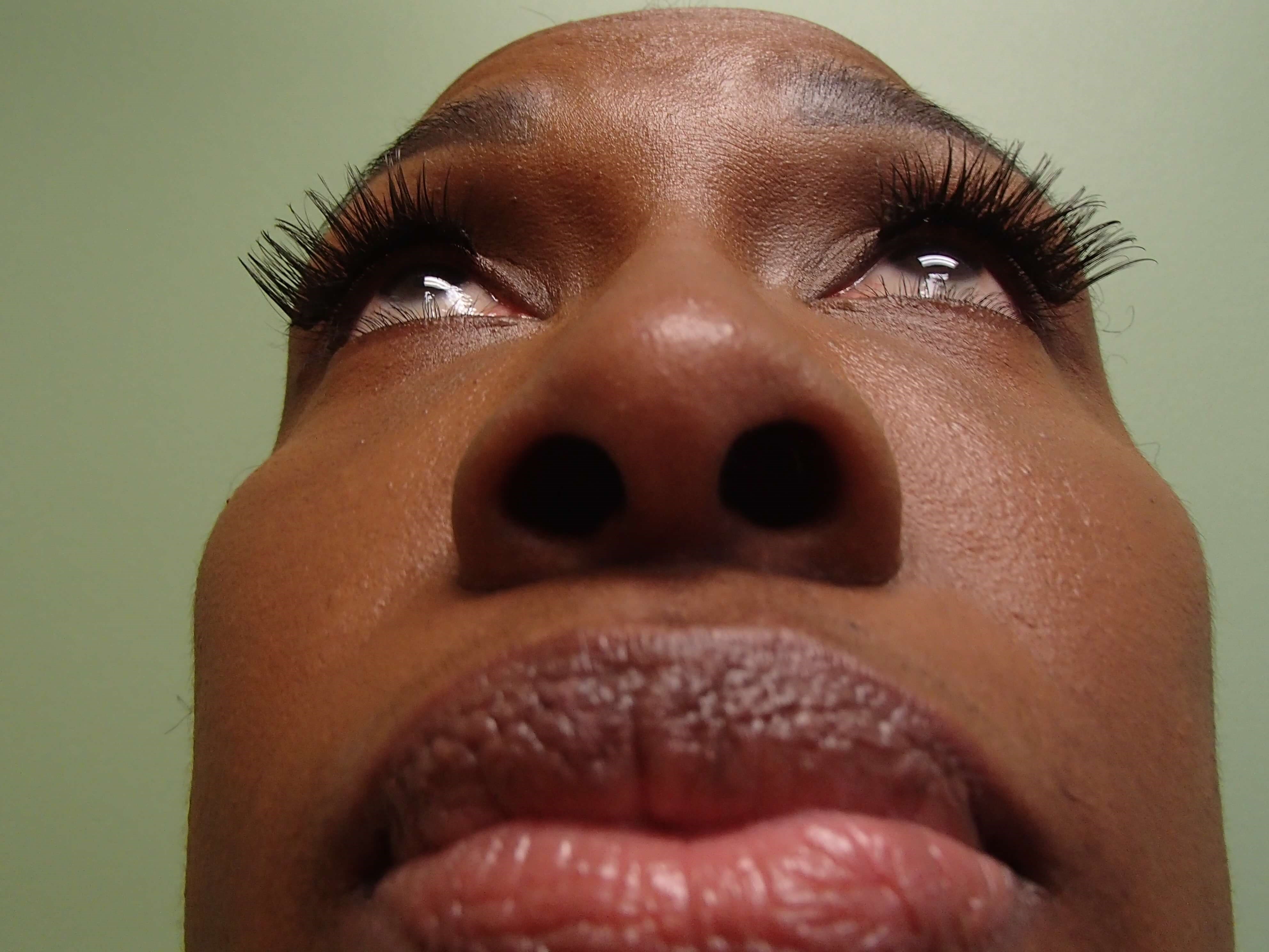 Rhinoplasty (Nose Job) Before