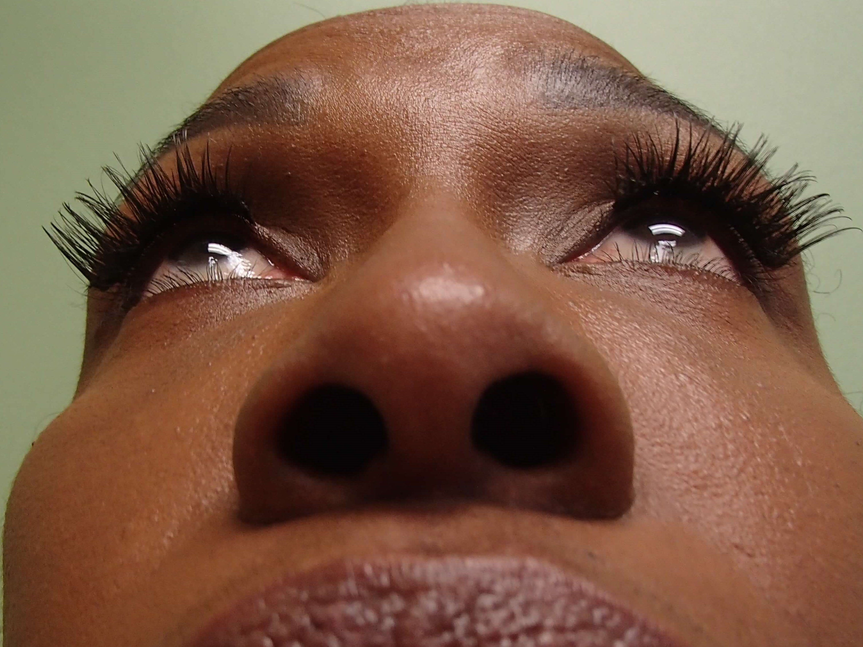 Rhinoplasty (Nose Job) Before