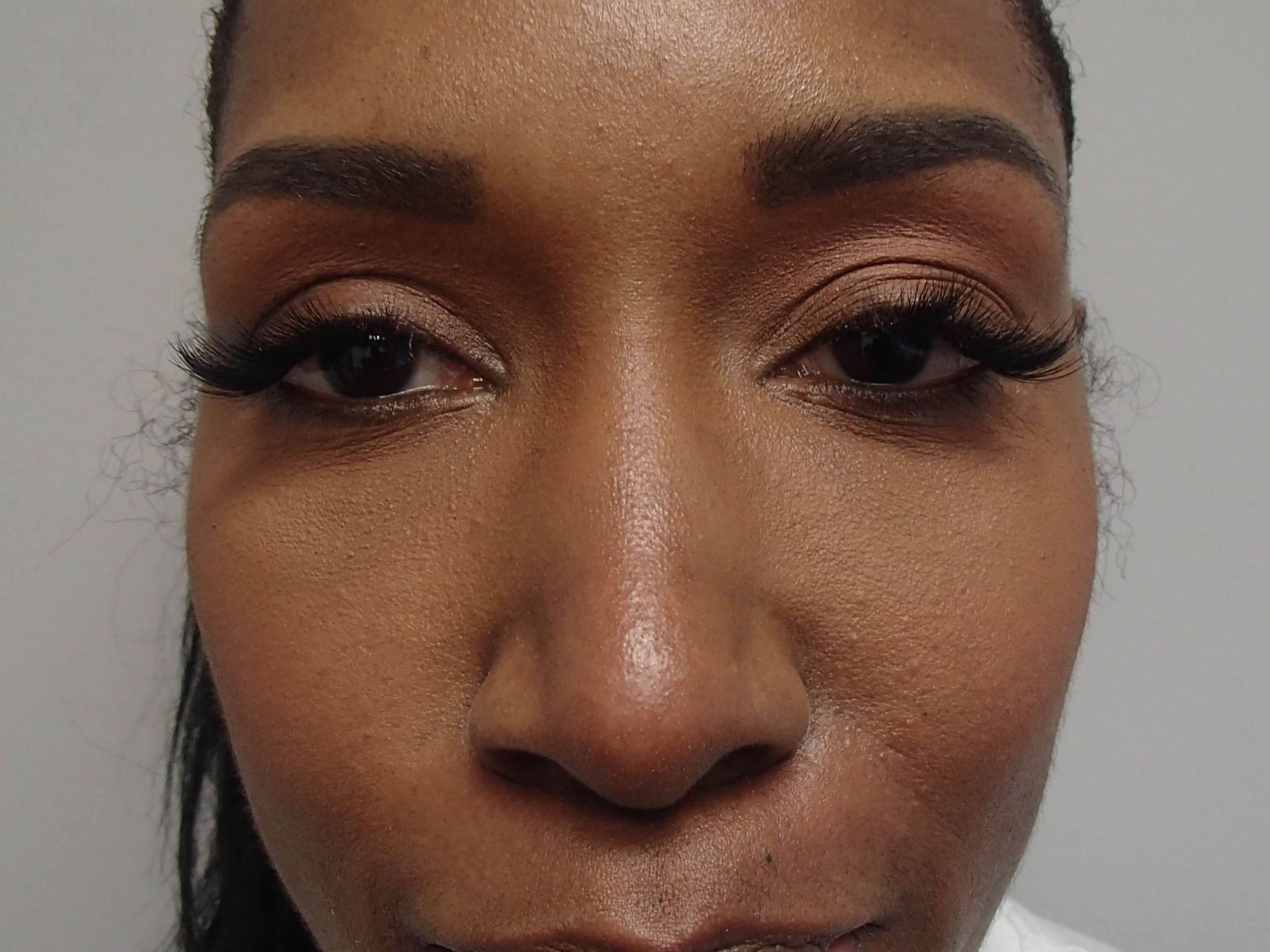 Rhinoplasty (Nose Job) After