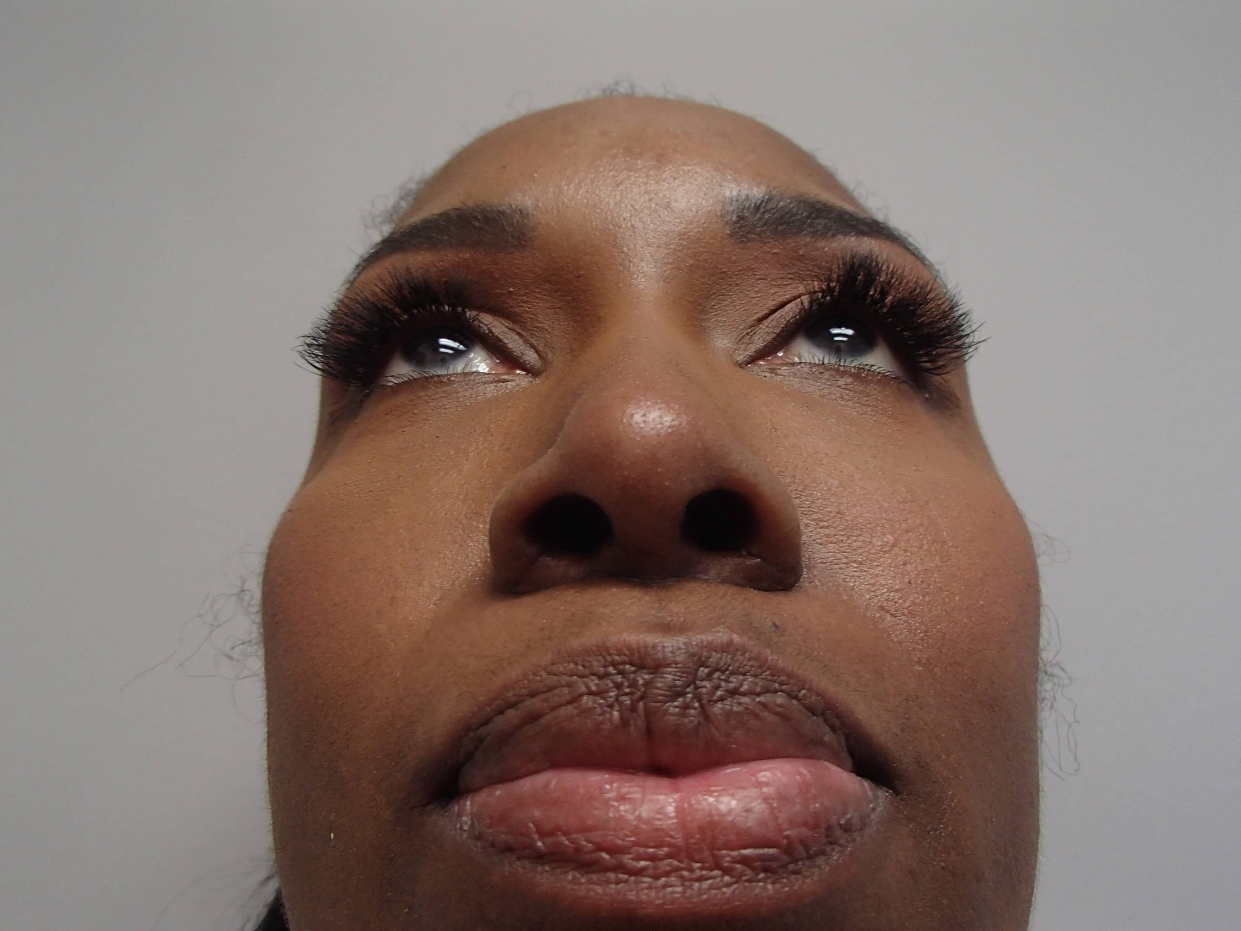 Rhinoplasty (Nose Job) After