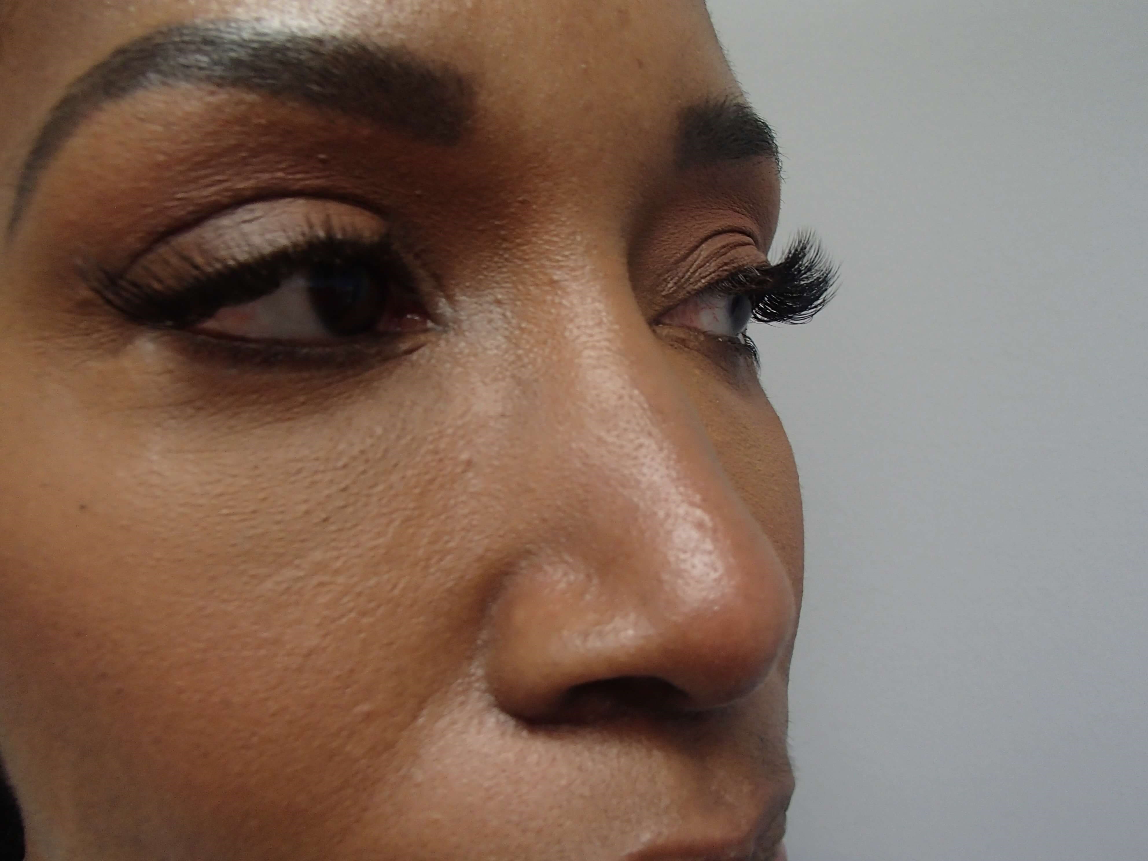 Rhinoplasty (Nose Job) After