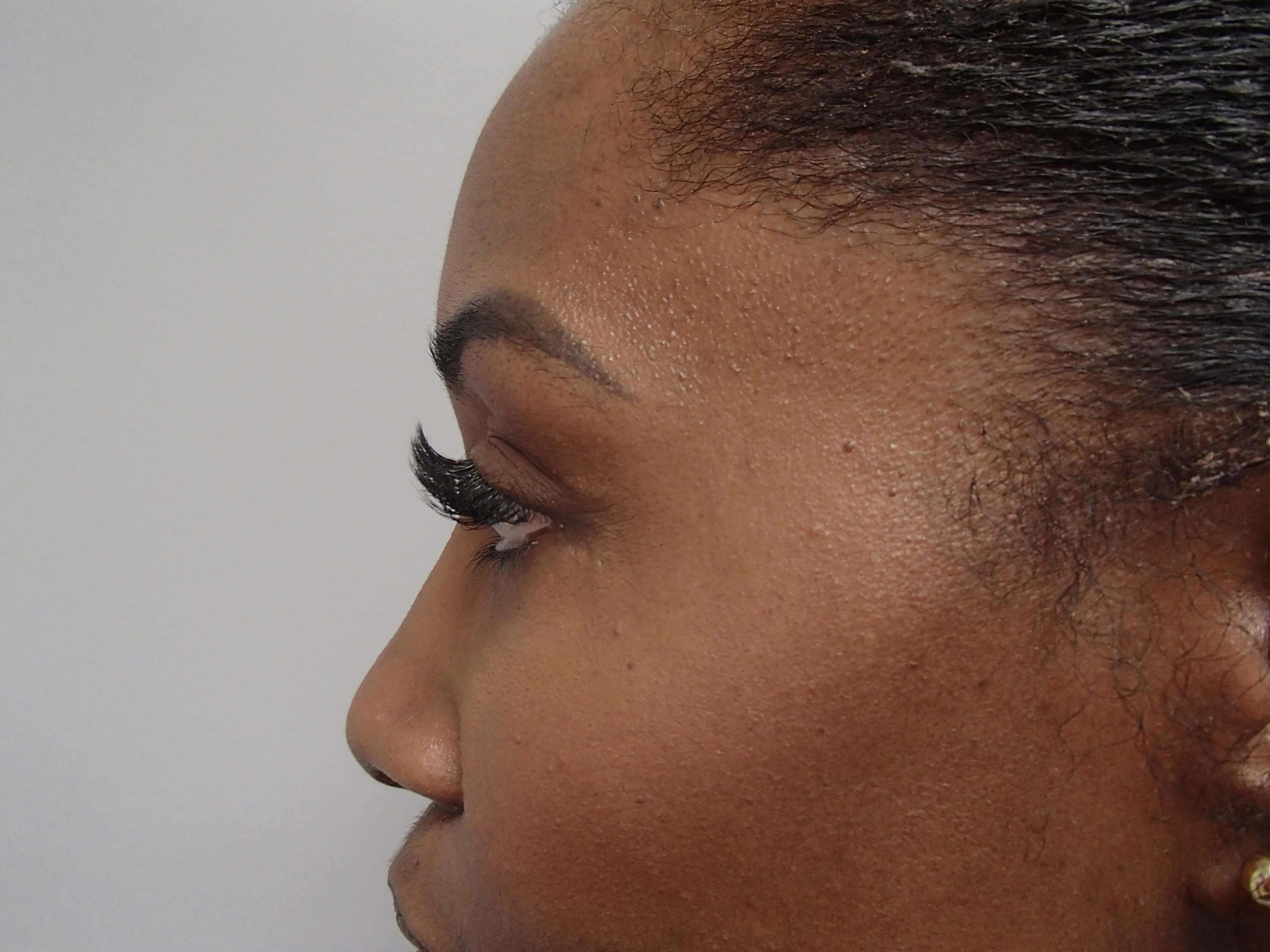 Rhinoplasty (Nose Job) After