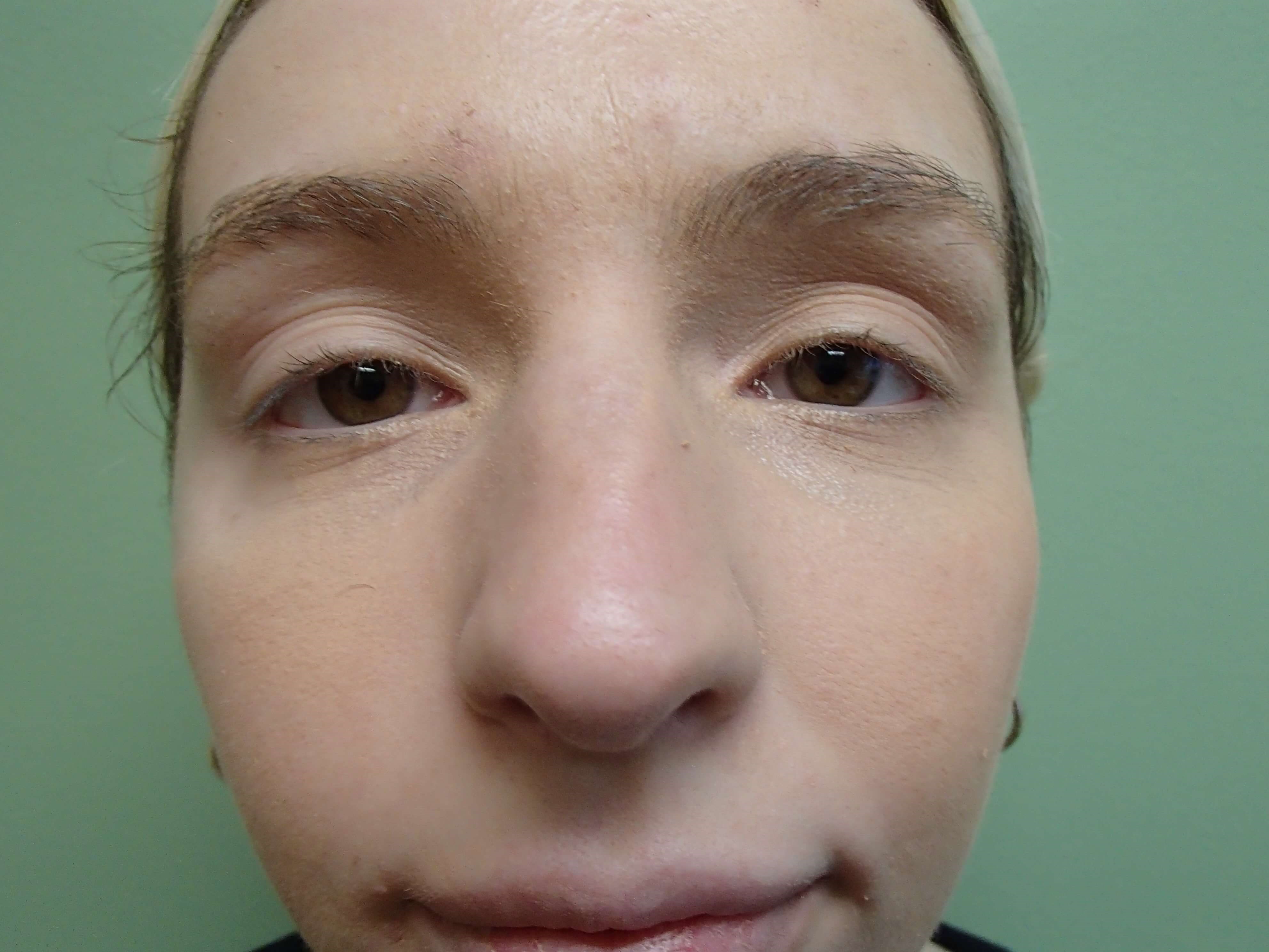 Rhinoplasty (Nose Job) Before