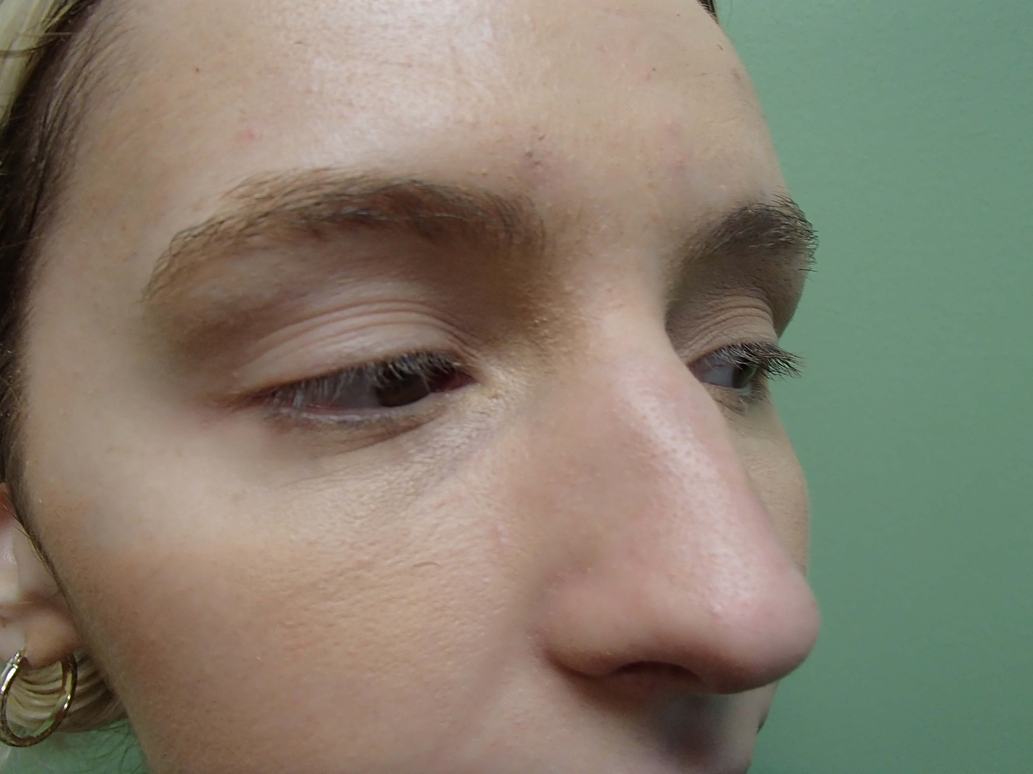 Rhinoplasty (Nose Job) Before