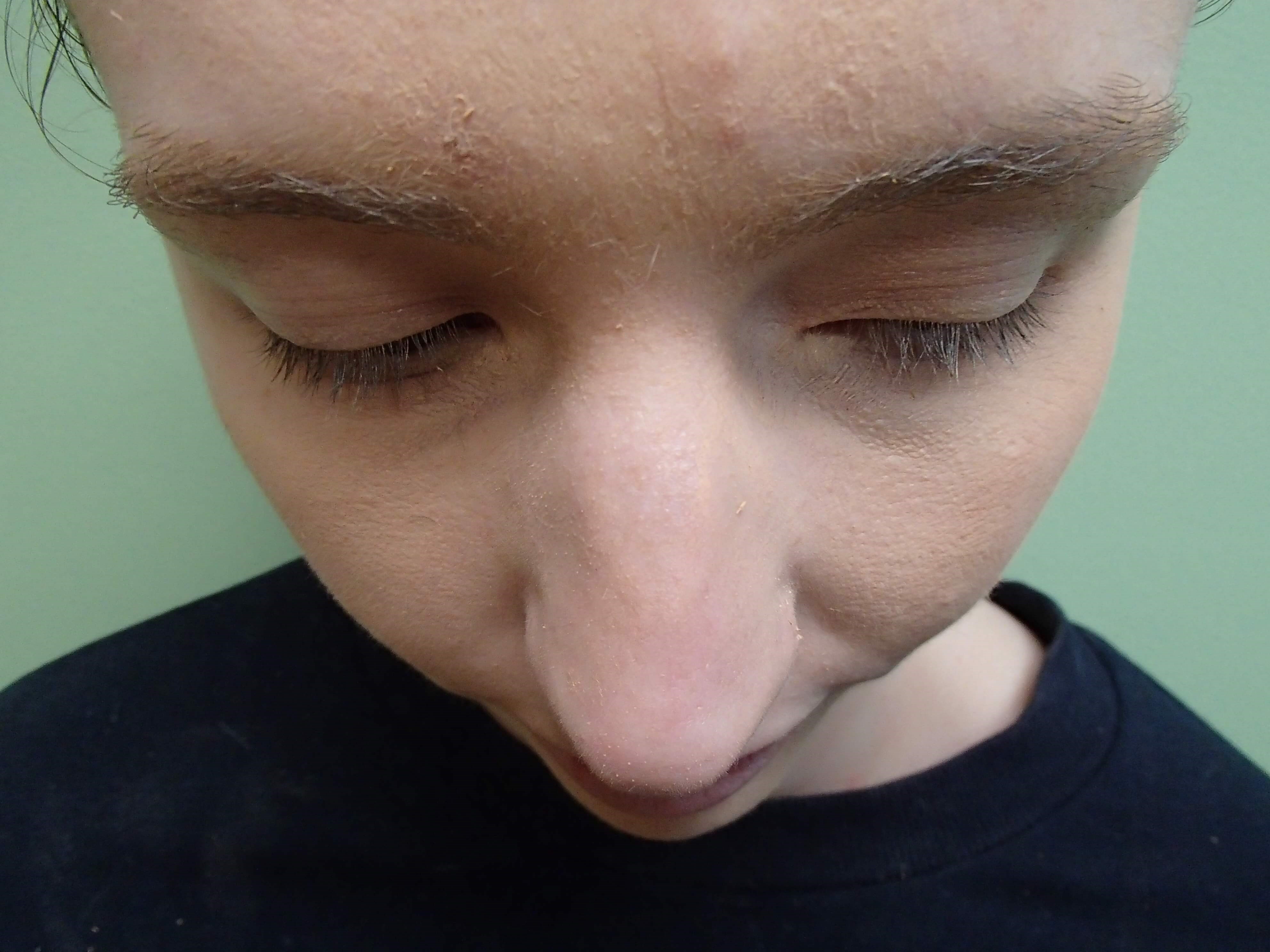 Rhinoplasty (Nose Job) Before
