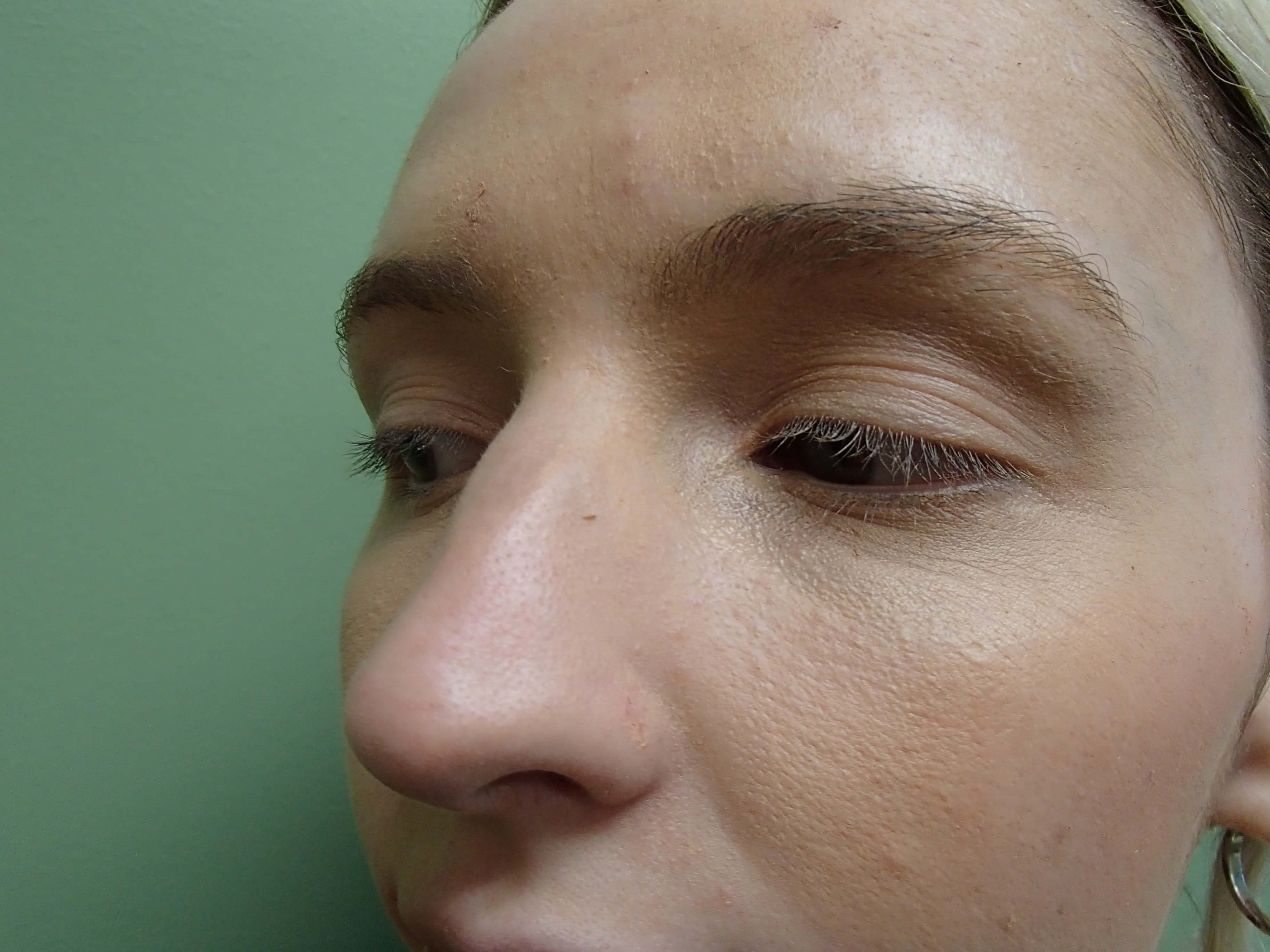 Rhinoplasty (Nose Job) Before
