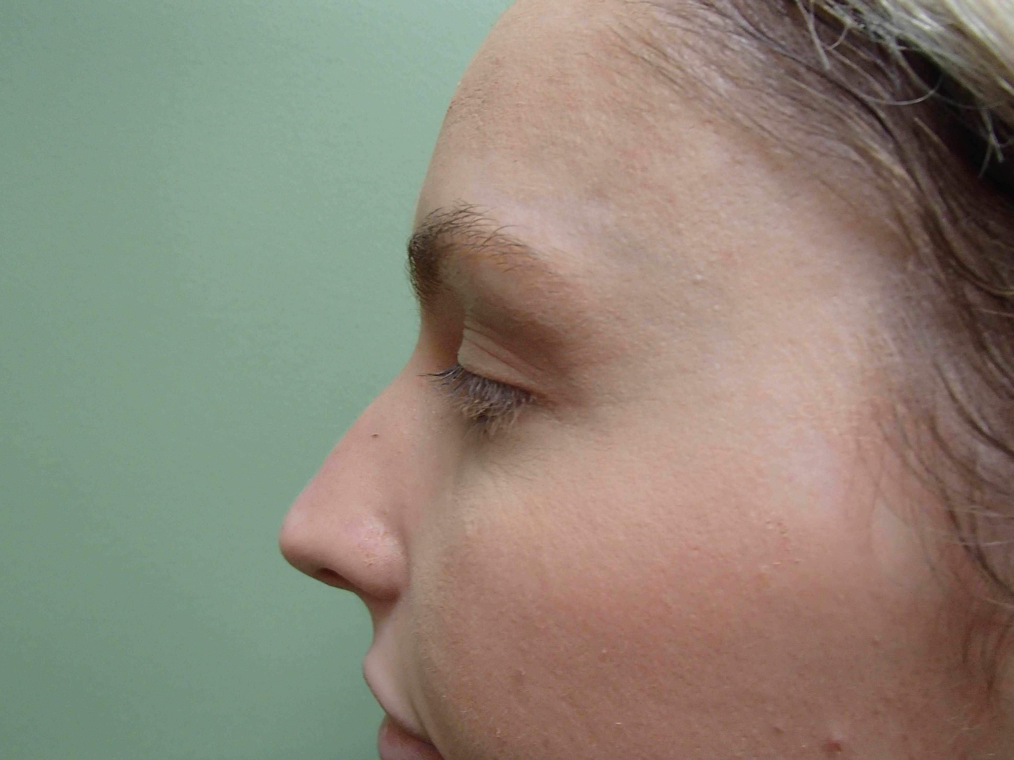 Rhinoplasty (Nose Job) Before