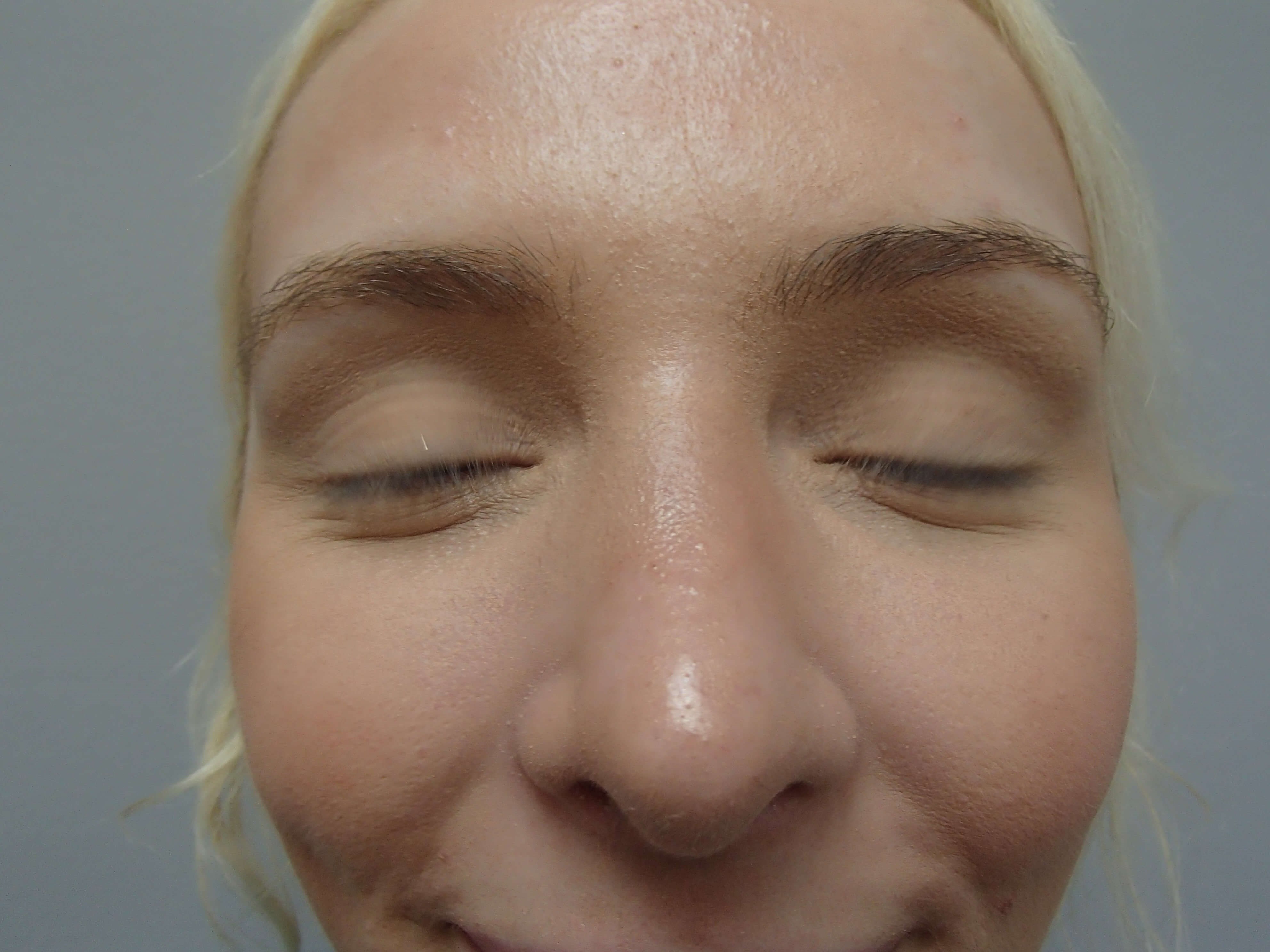 Rhinoplasty (Nose Job) After