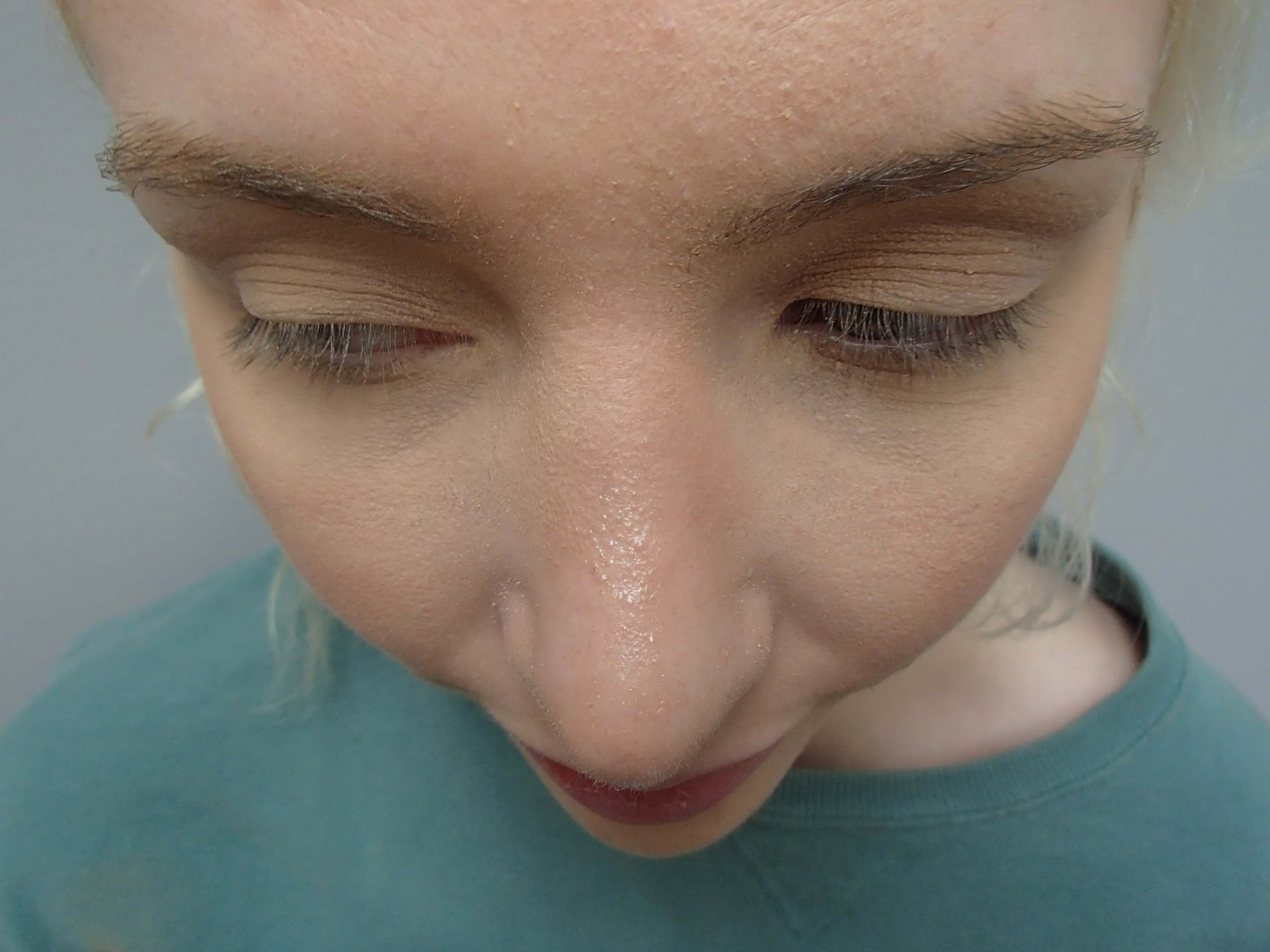 Rhinoplasty (Nose Job) After