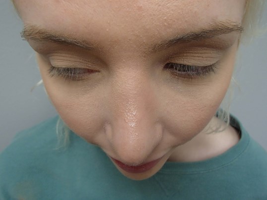 Rhinoplasty (Nose Job) After