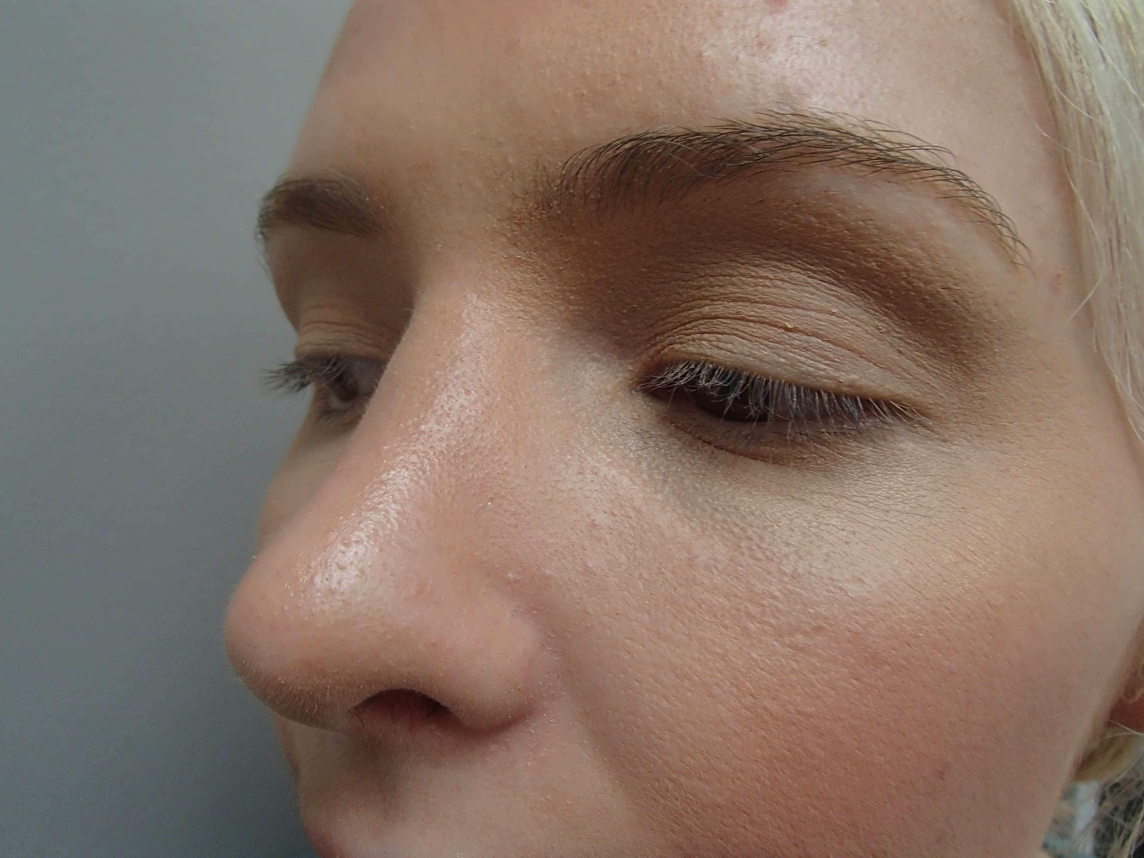 Rhinoplasty (Nose Job) After