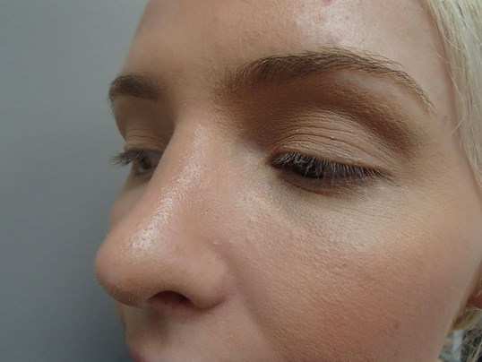 Rhinoplasty (Nose Job) After