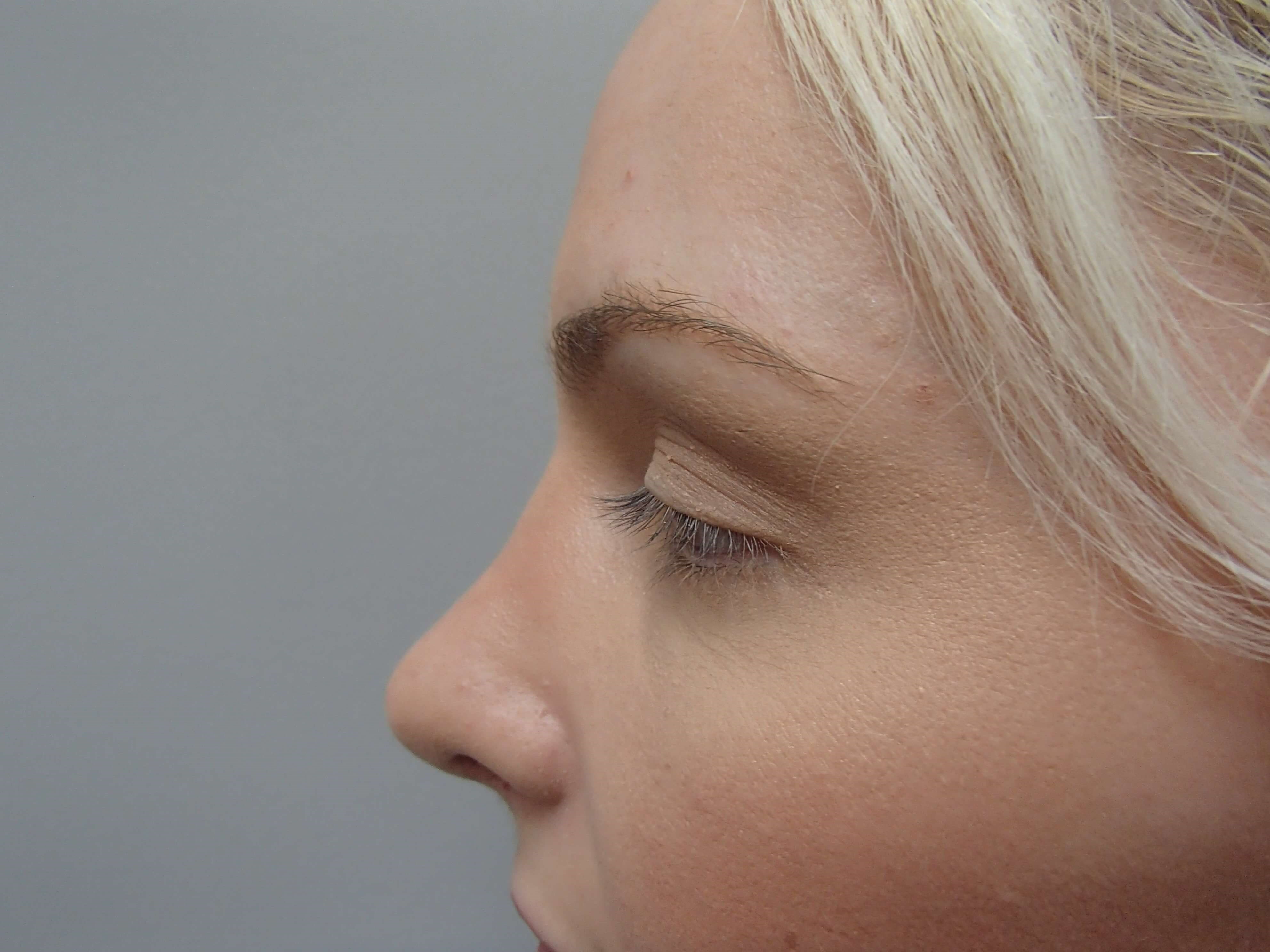 Rhinoplasty (Nose Job) After