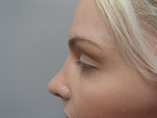 Rhinoplasty (Nose Job) After
