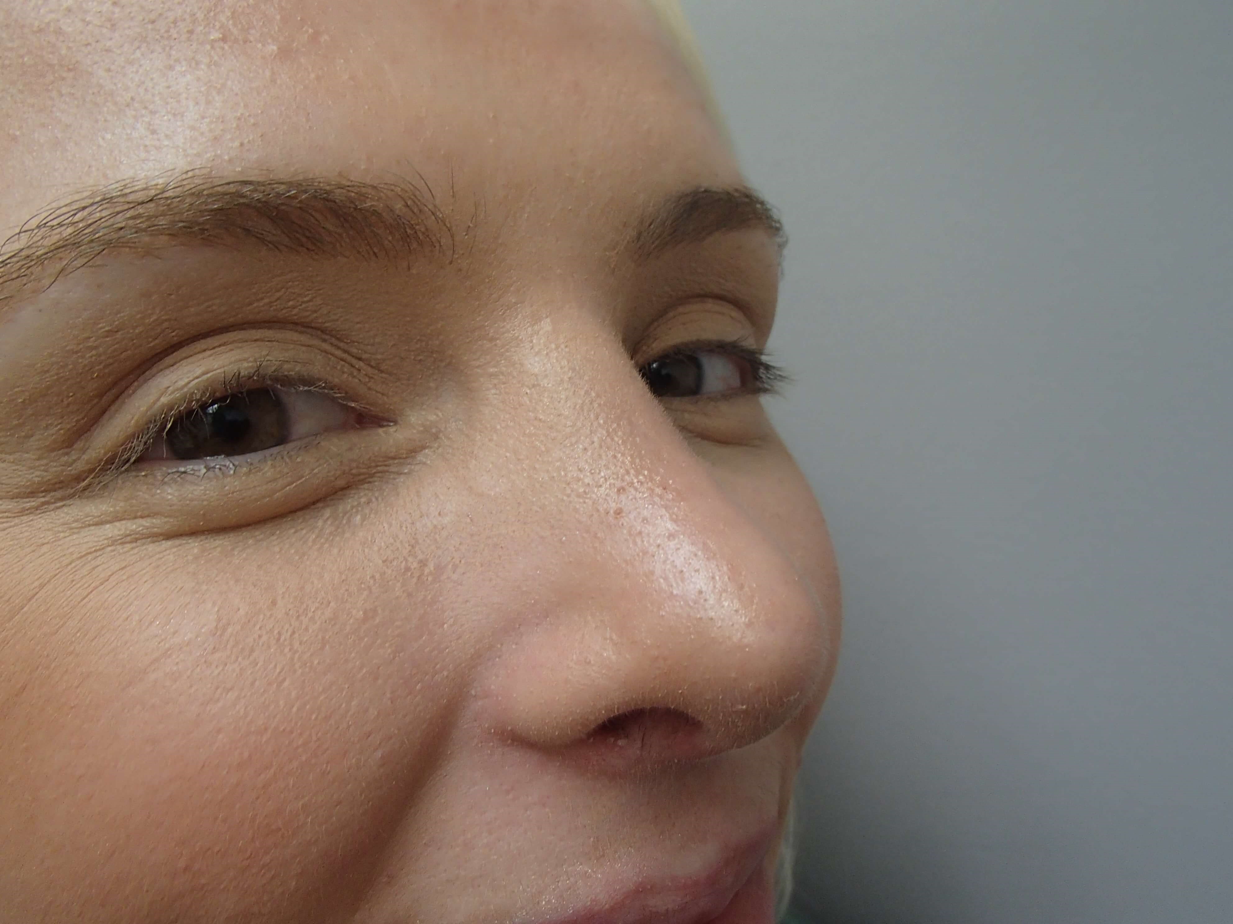 Rhinoplasty (Nose Job) After