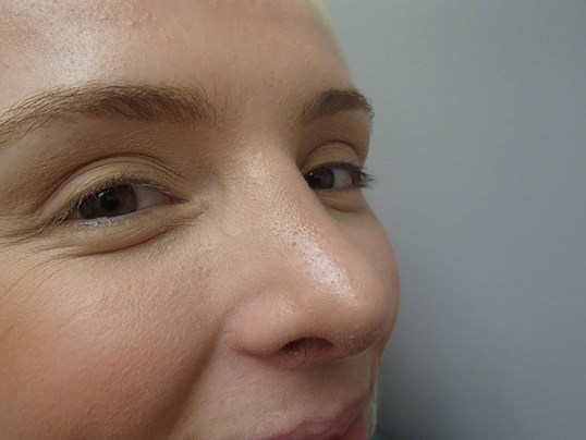 Rhinoplasty (Nose Job) After