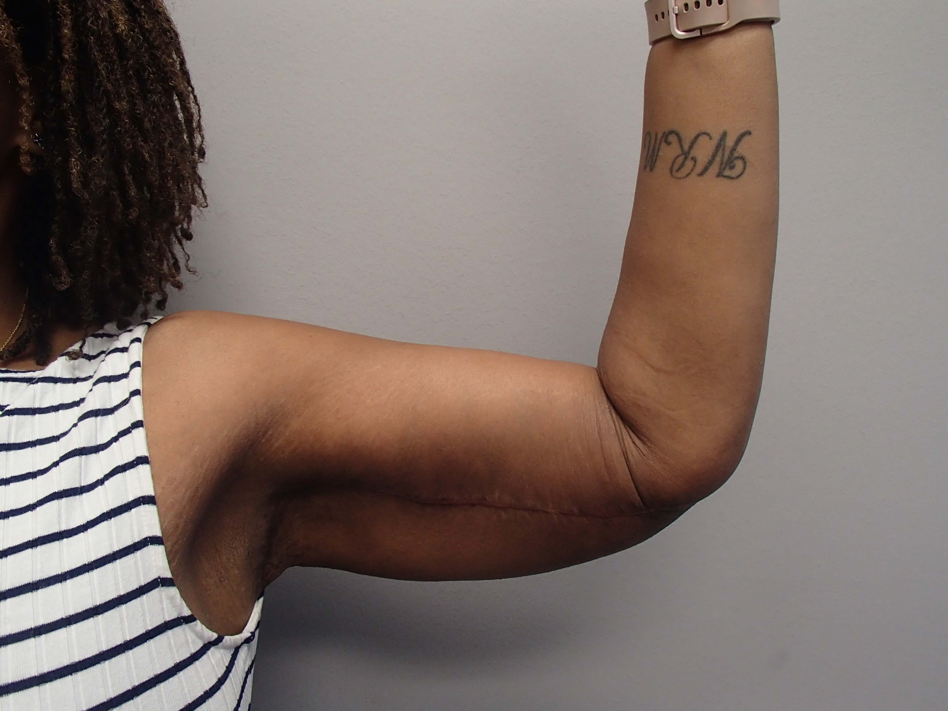 Brachioplasty (Arm Lift) After