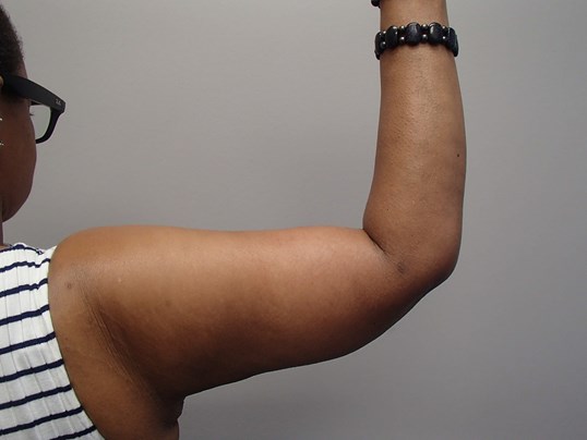 Brachioplasty (Arm Lift) After