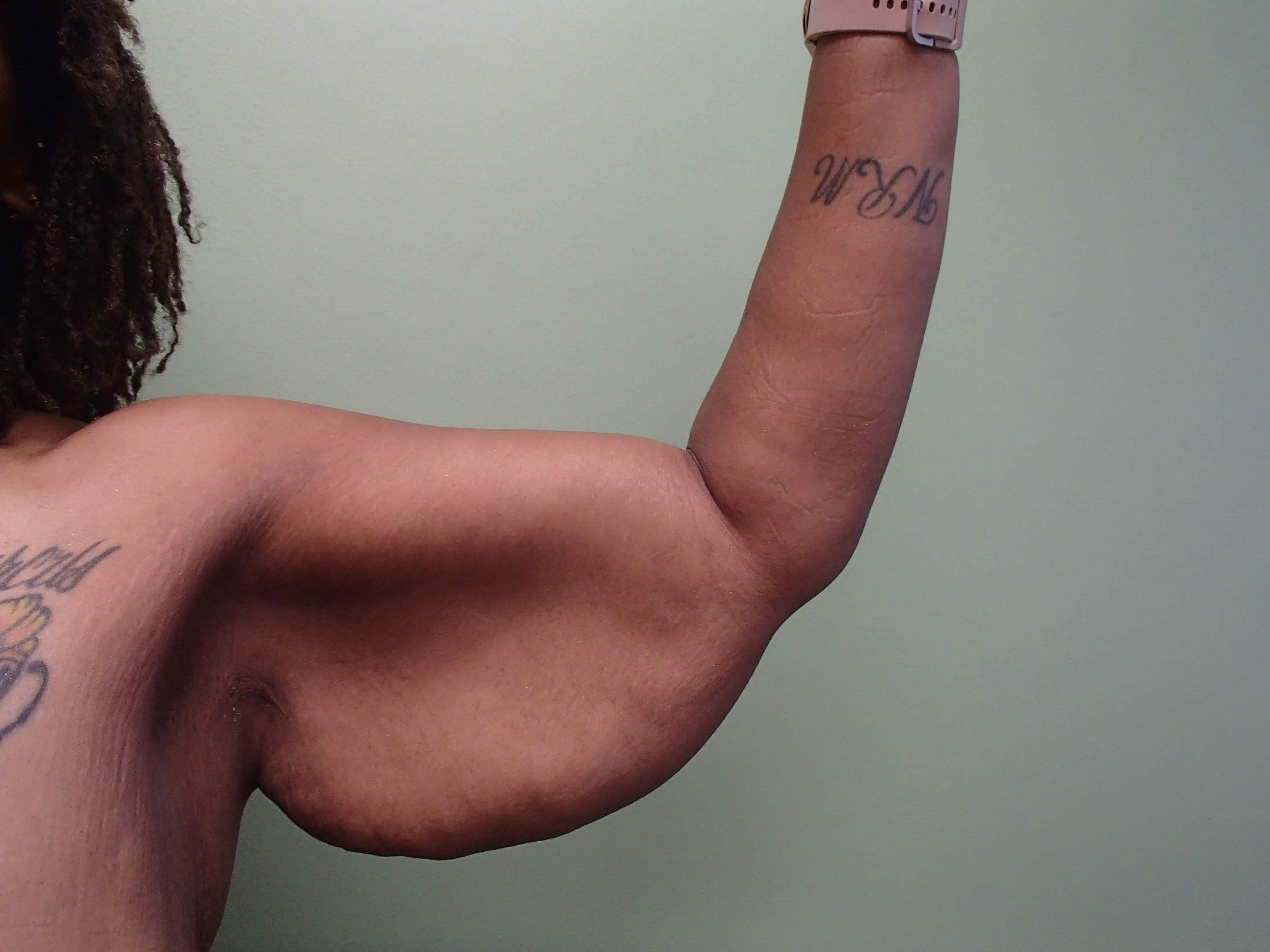 Brachioplasty (Arm Lift) Before