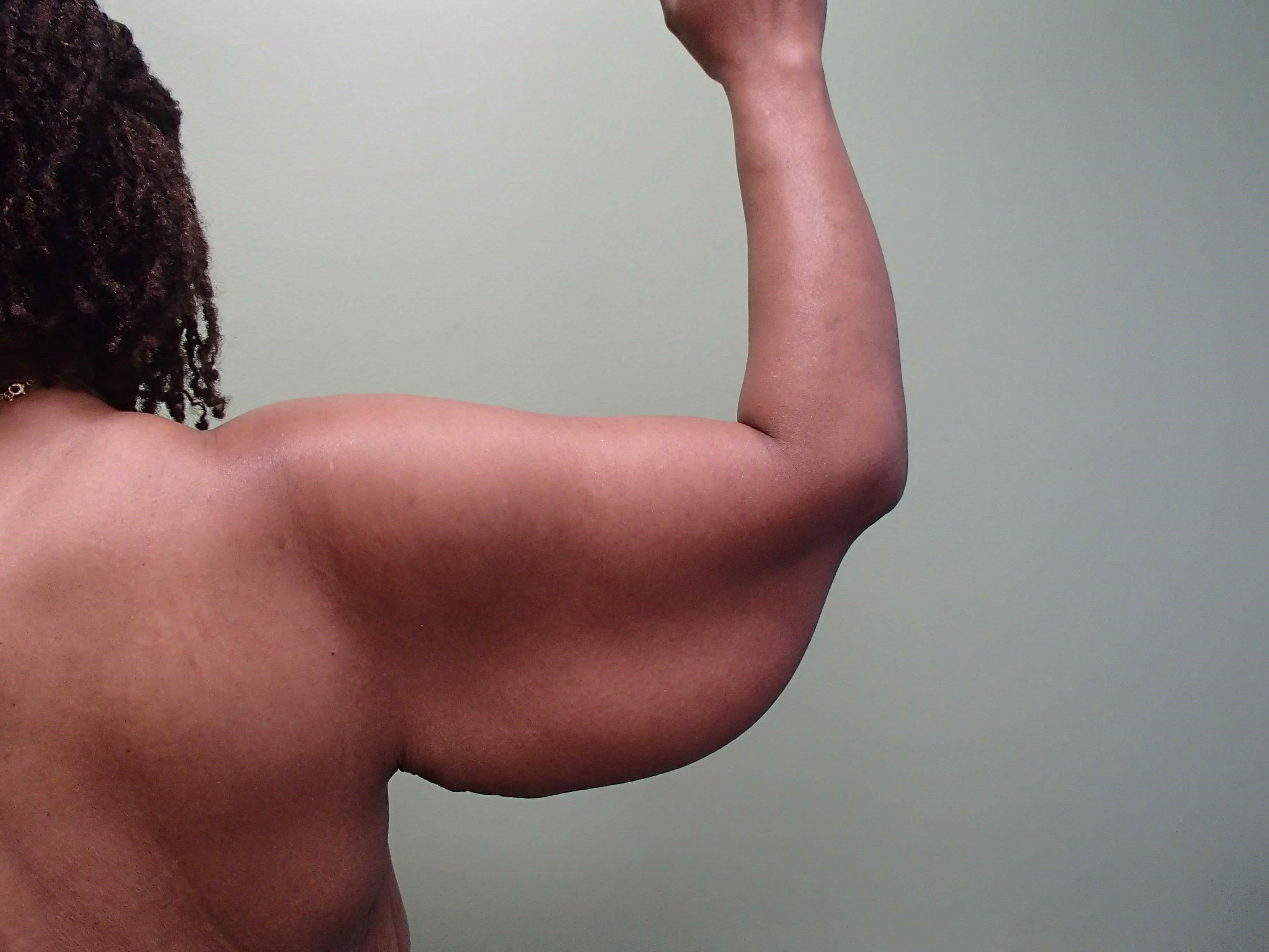 Brachioplasty (Arm Lift) Before