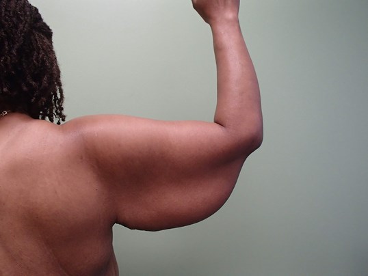 Brachioplasty (Arm Lift) Before