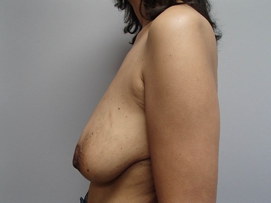 Breast Lift with Implants Before