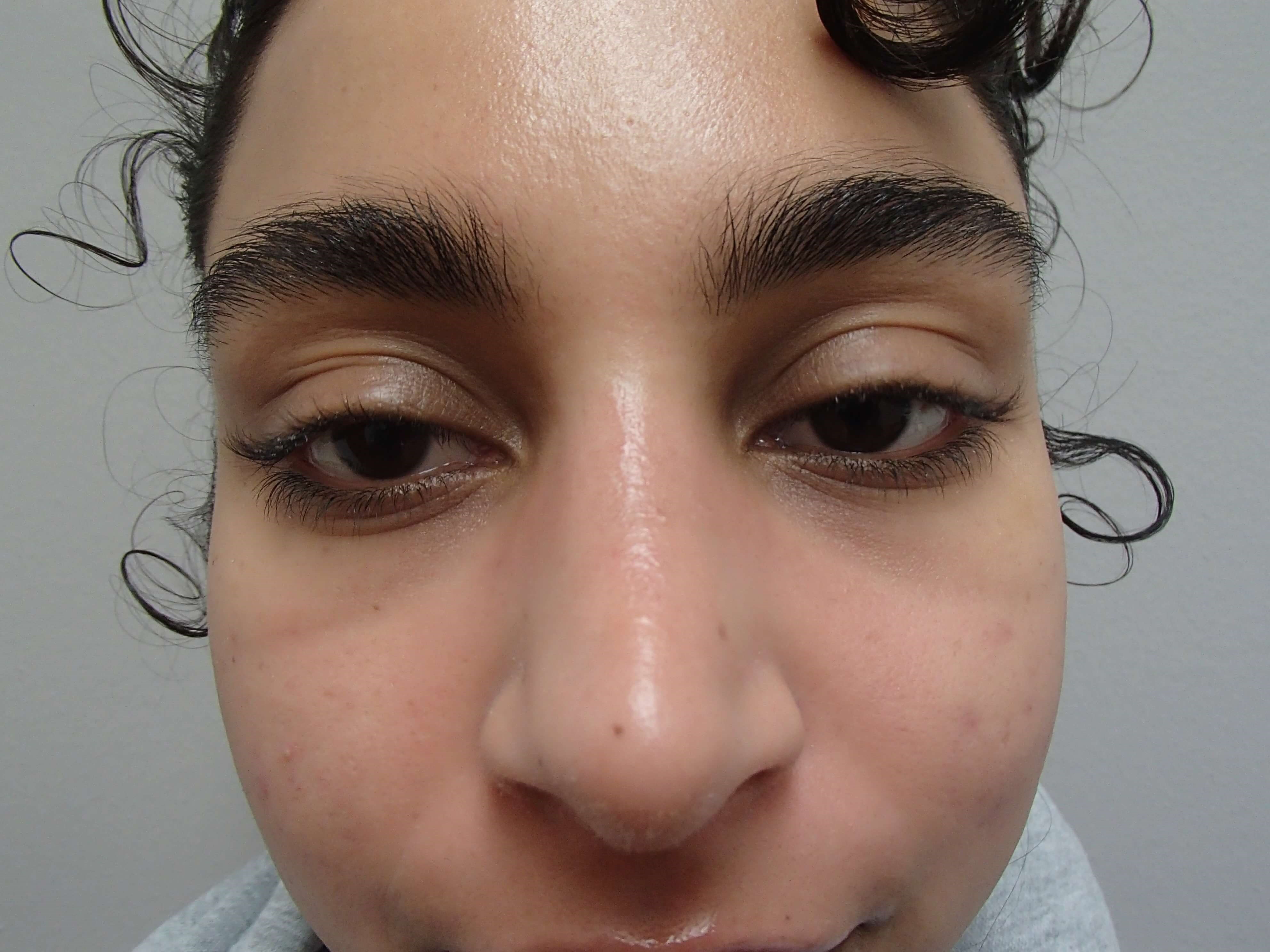 Rhinoplasty (Nose Job) After