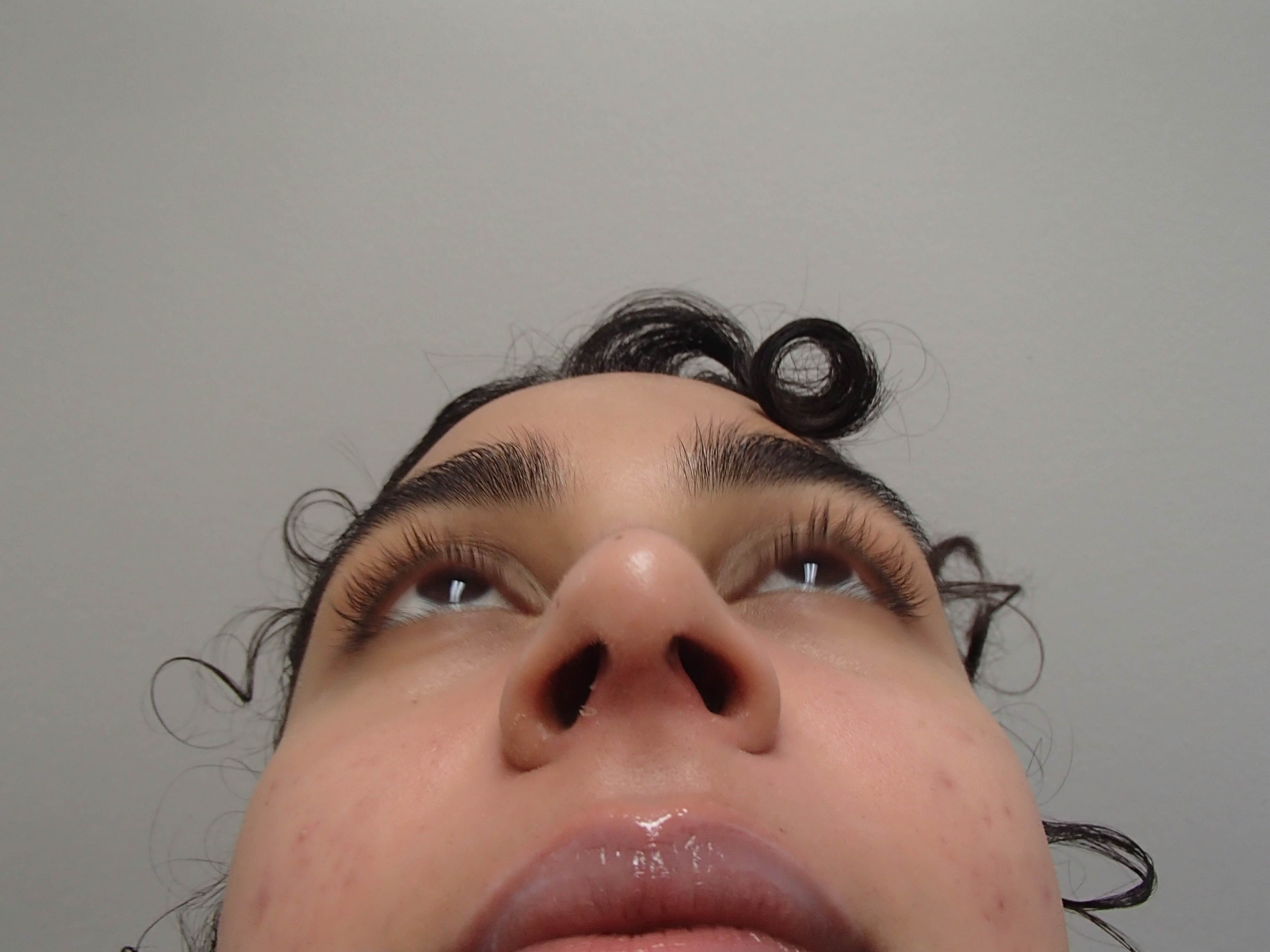 Rhinoplasty (Nose Job) After