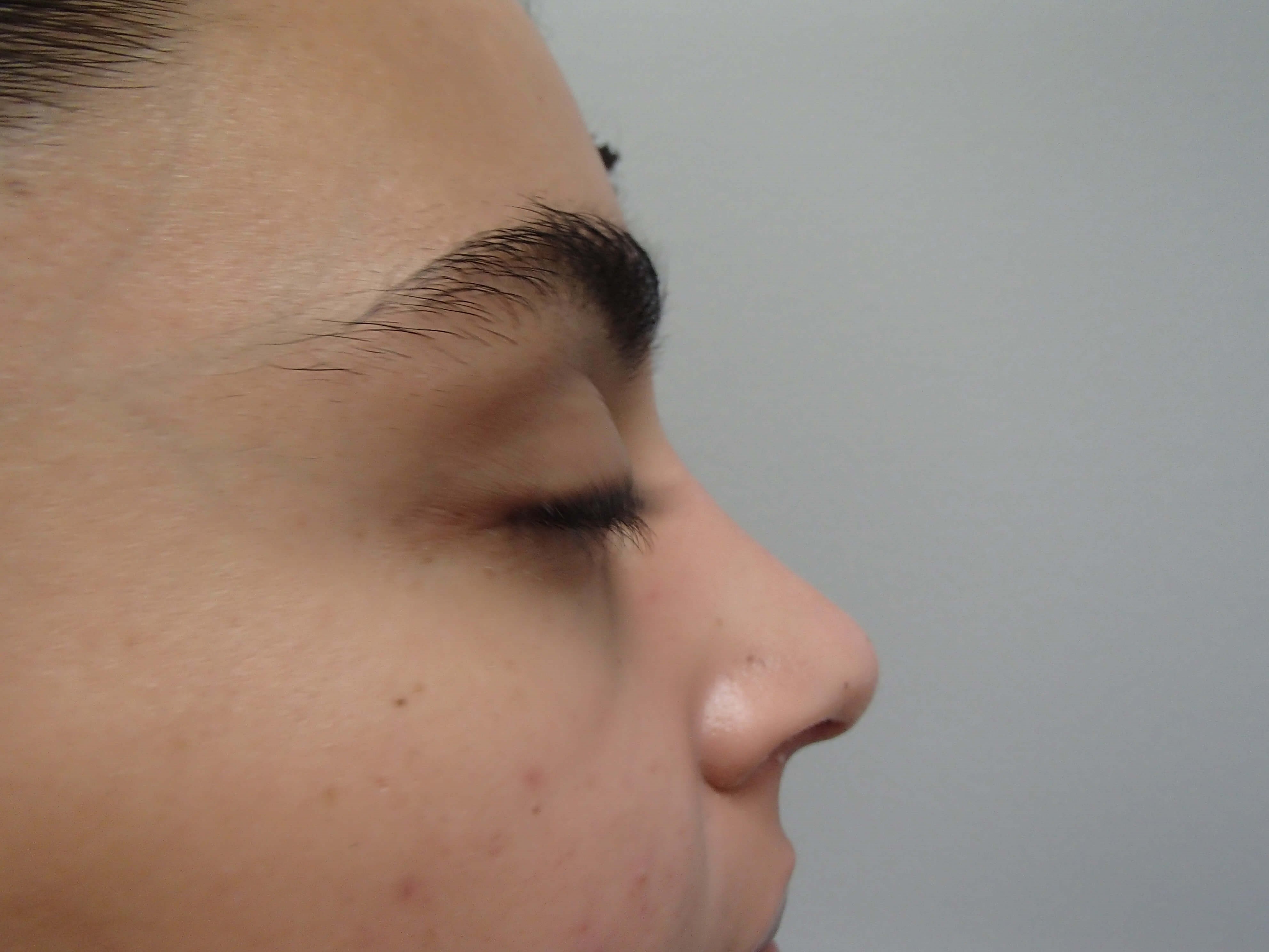 Rhinoplasty (Nose Job) After