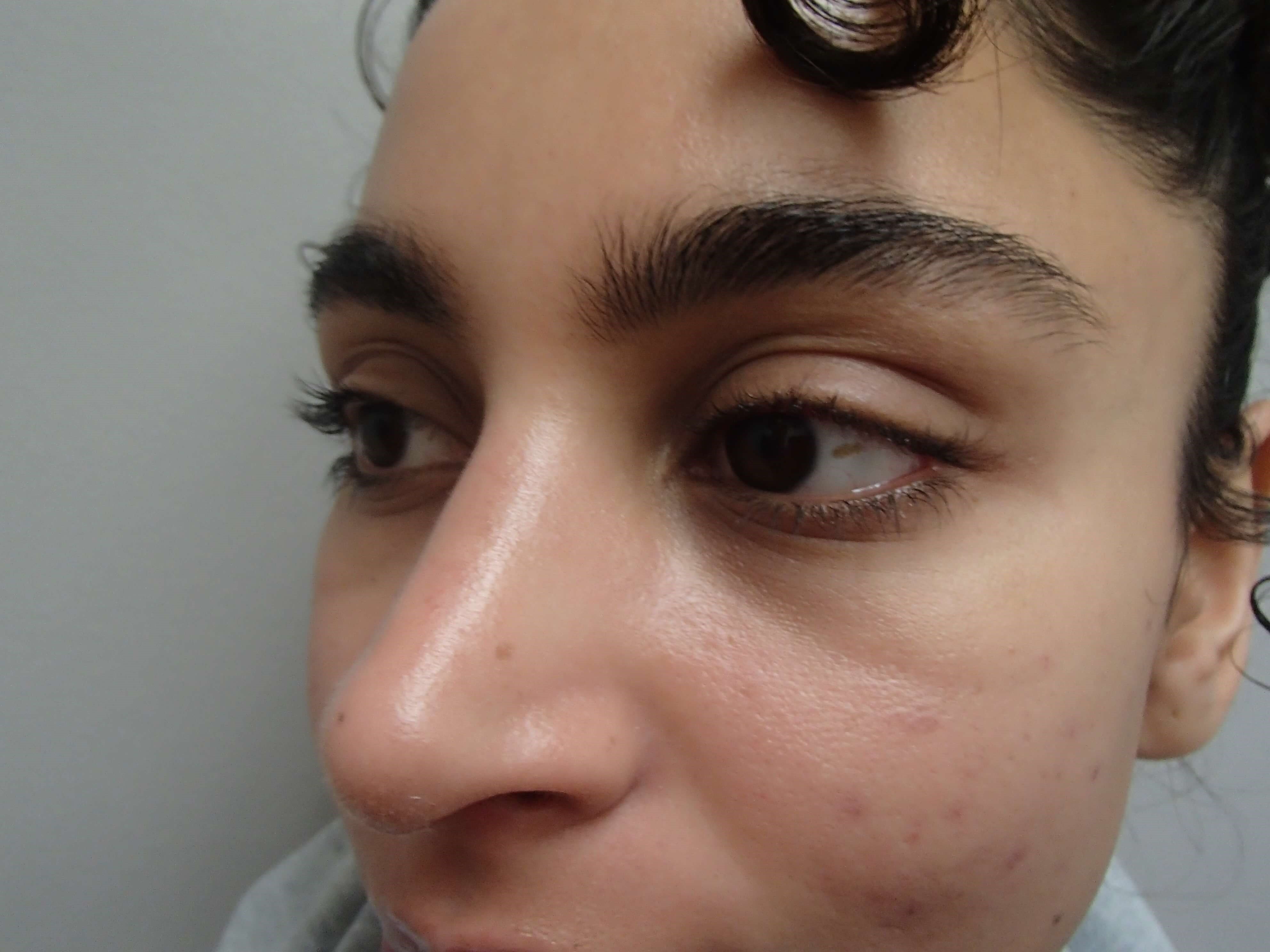 Rhinoplasty (Nose Job) After