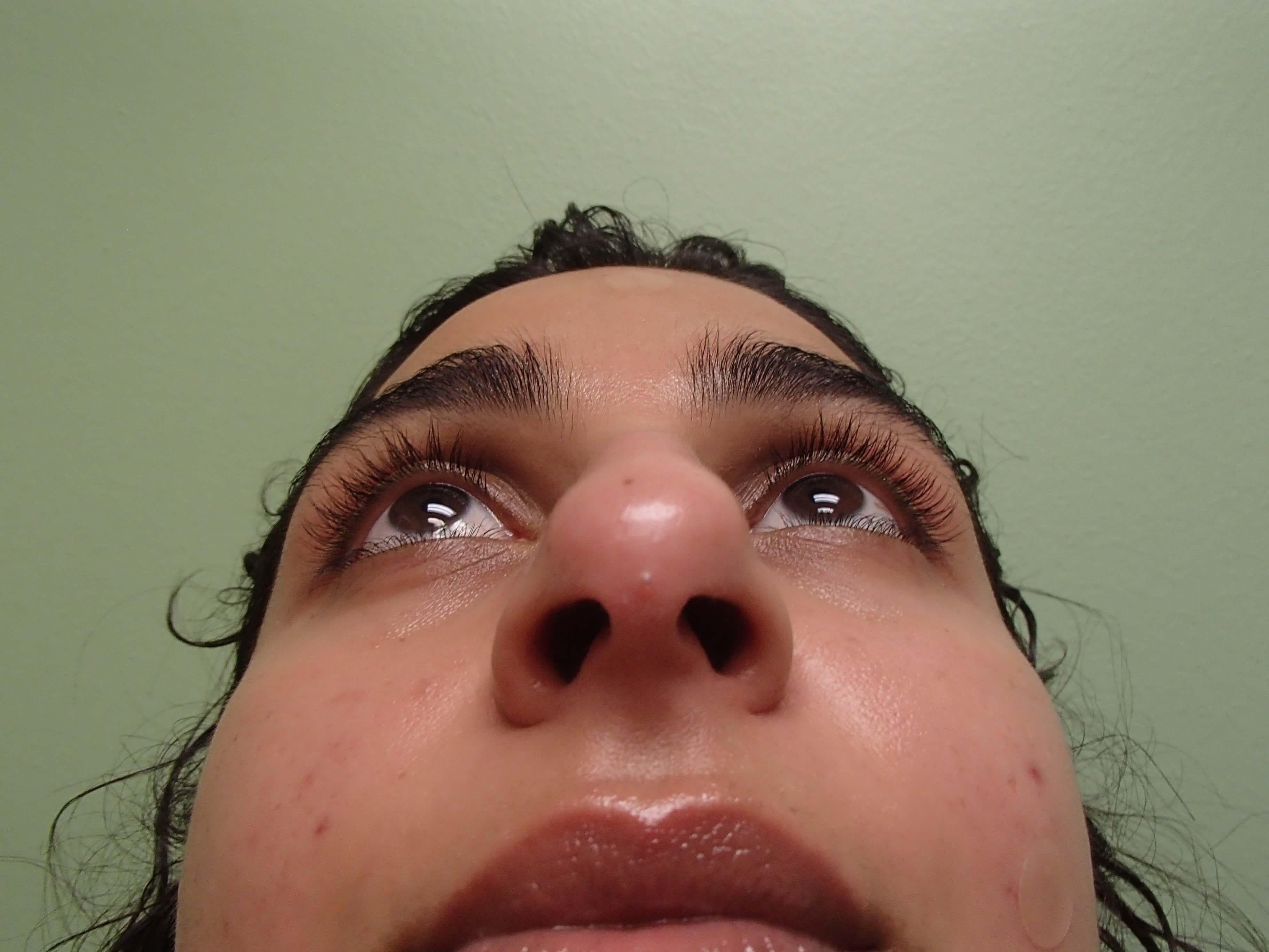 Rhinoplasty (Nose Job) Before