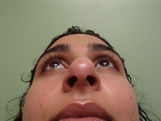 Rhinoplasty (Nose Job) Before