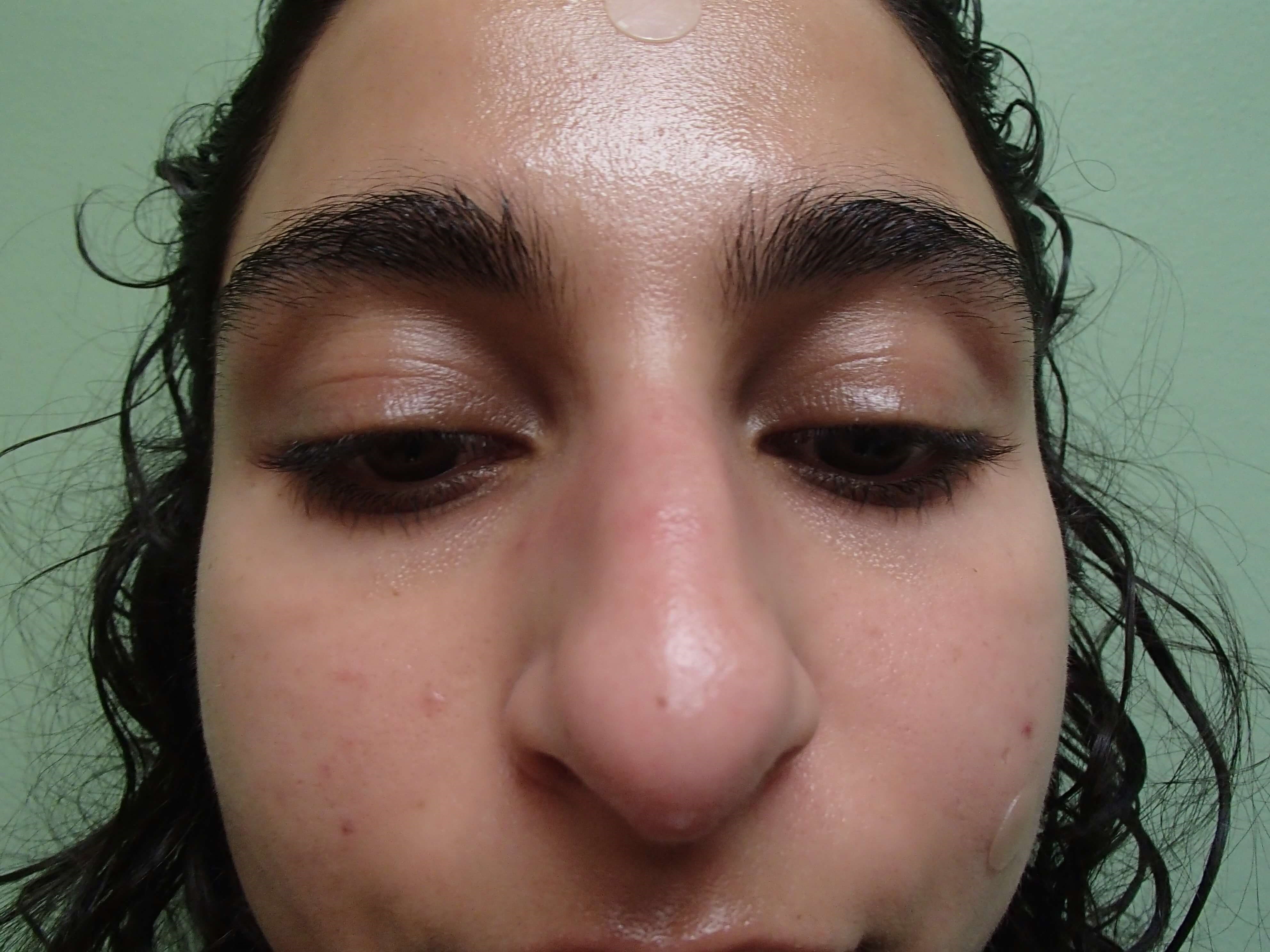 Rhinoplasty (Nose Job) Before