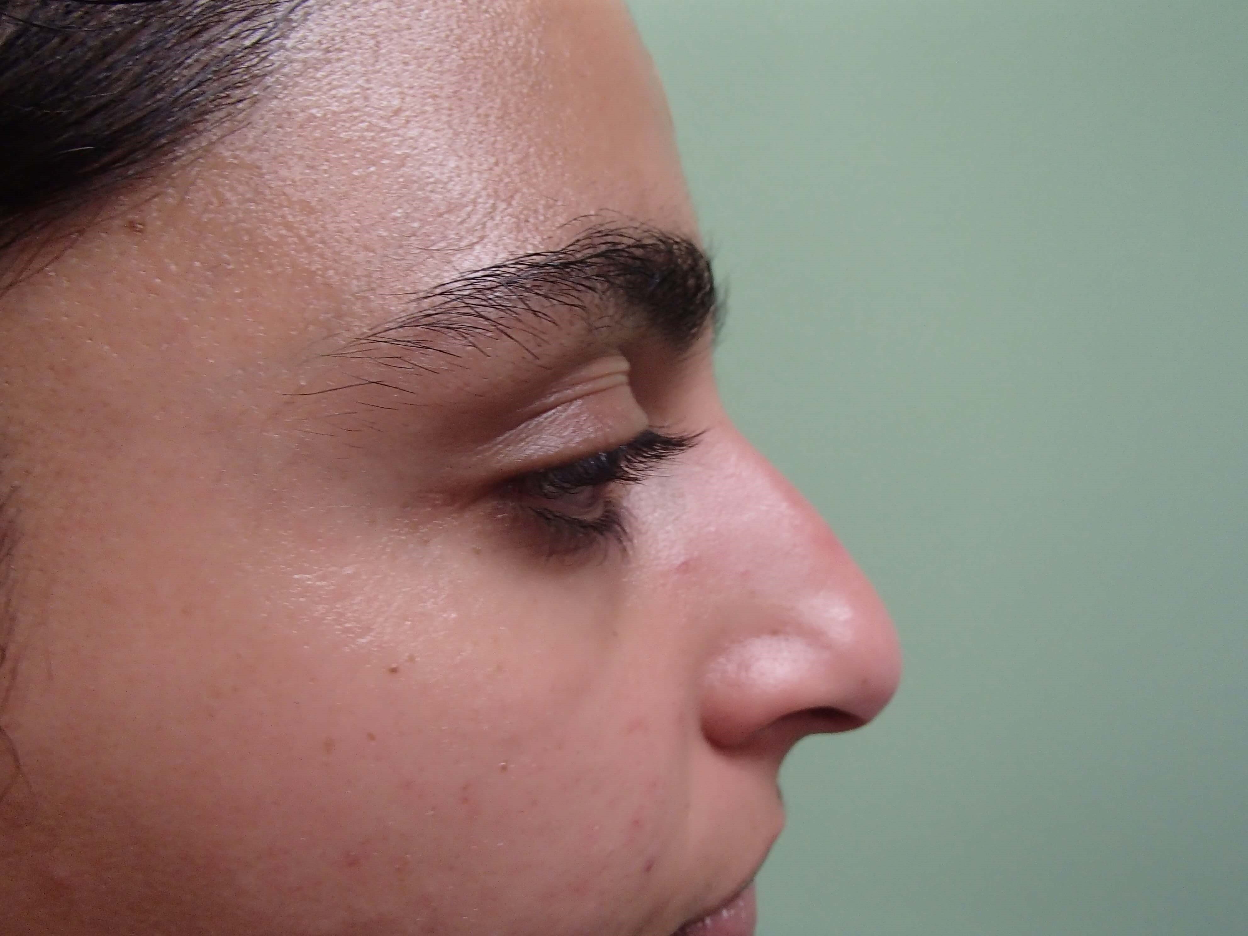 Rhinoplasty (Nose Job) Before