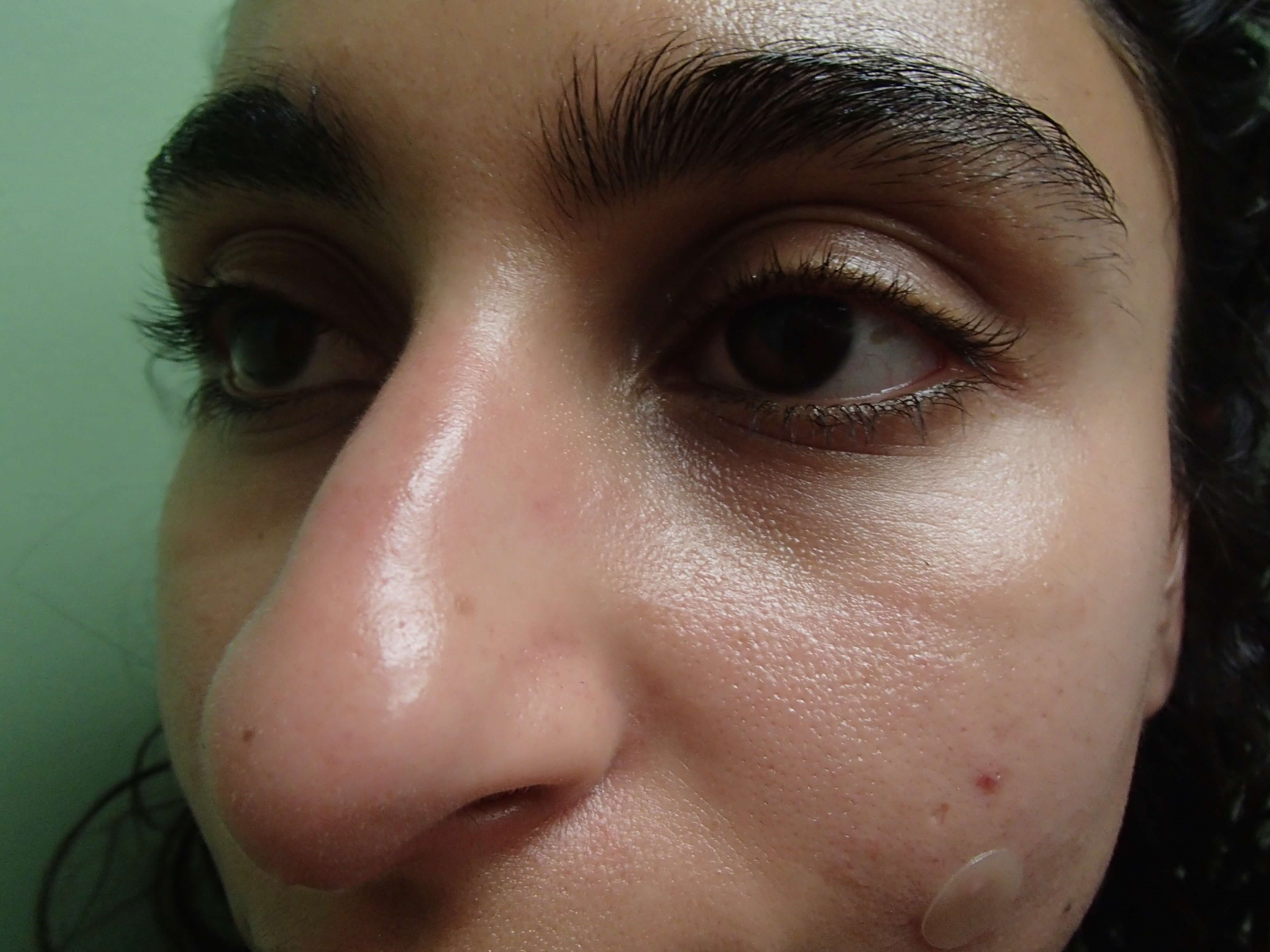 Rhinoplasty (Nose Job) Before