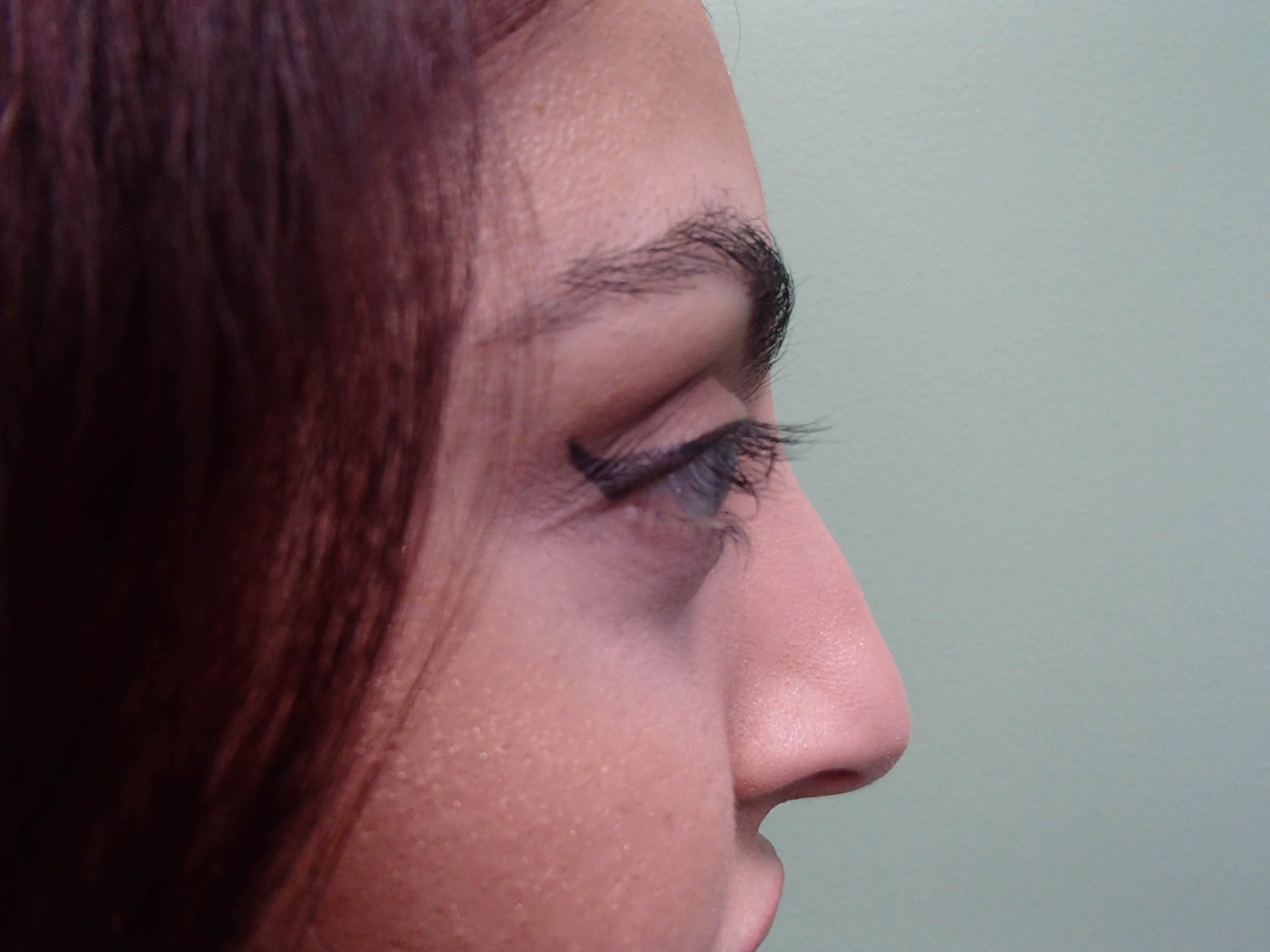 Rhinoplasty (Nose Job) Before