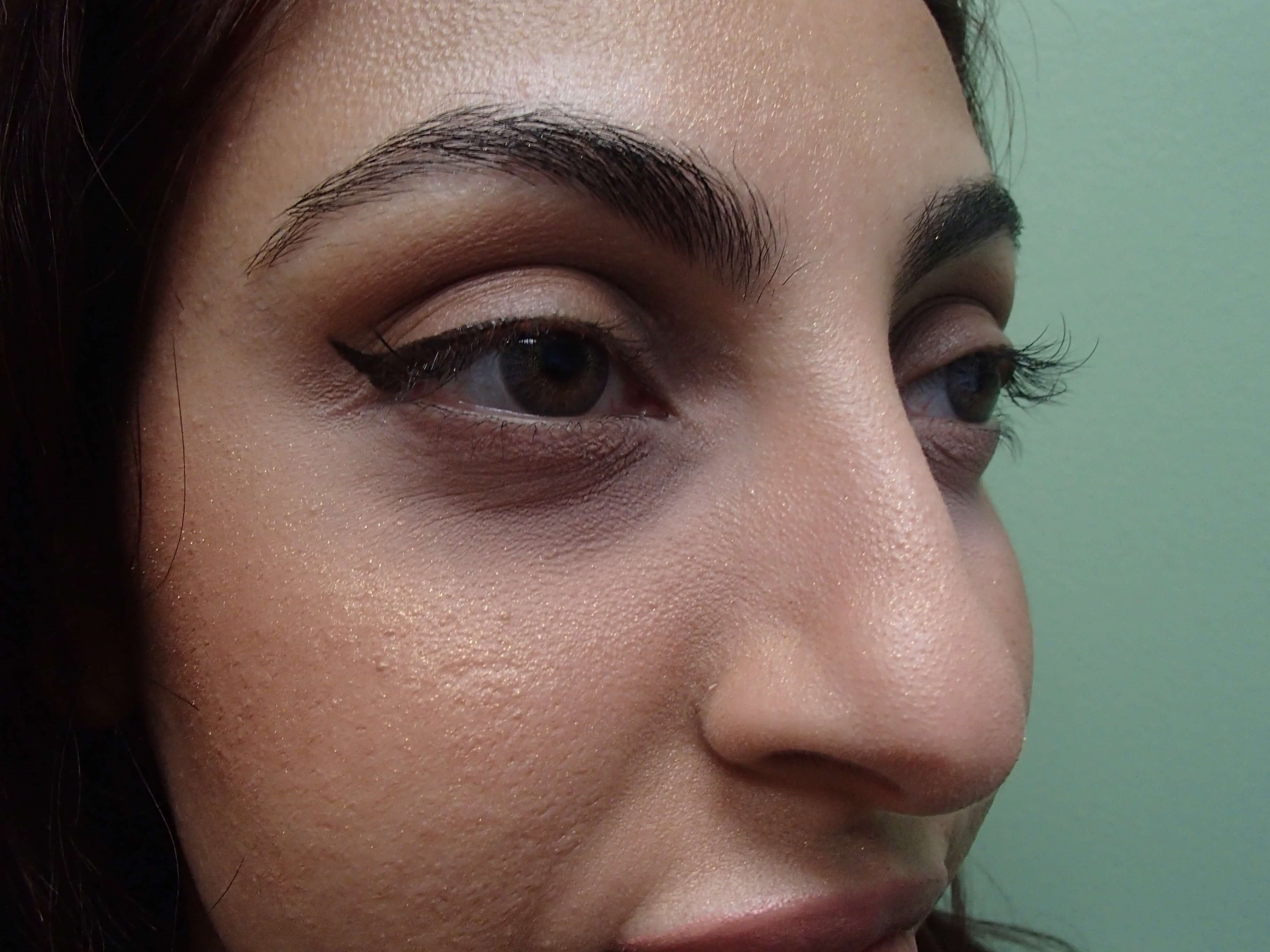 Rhinoplasty (Nose Job) Before