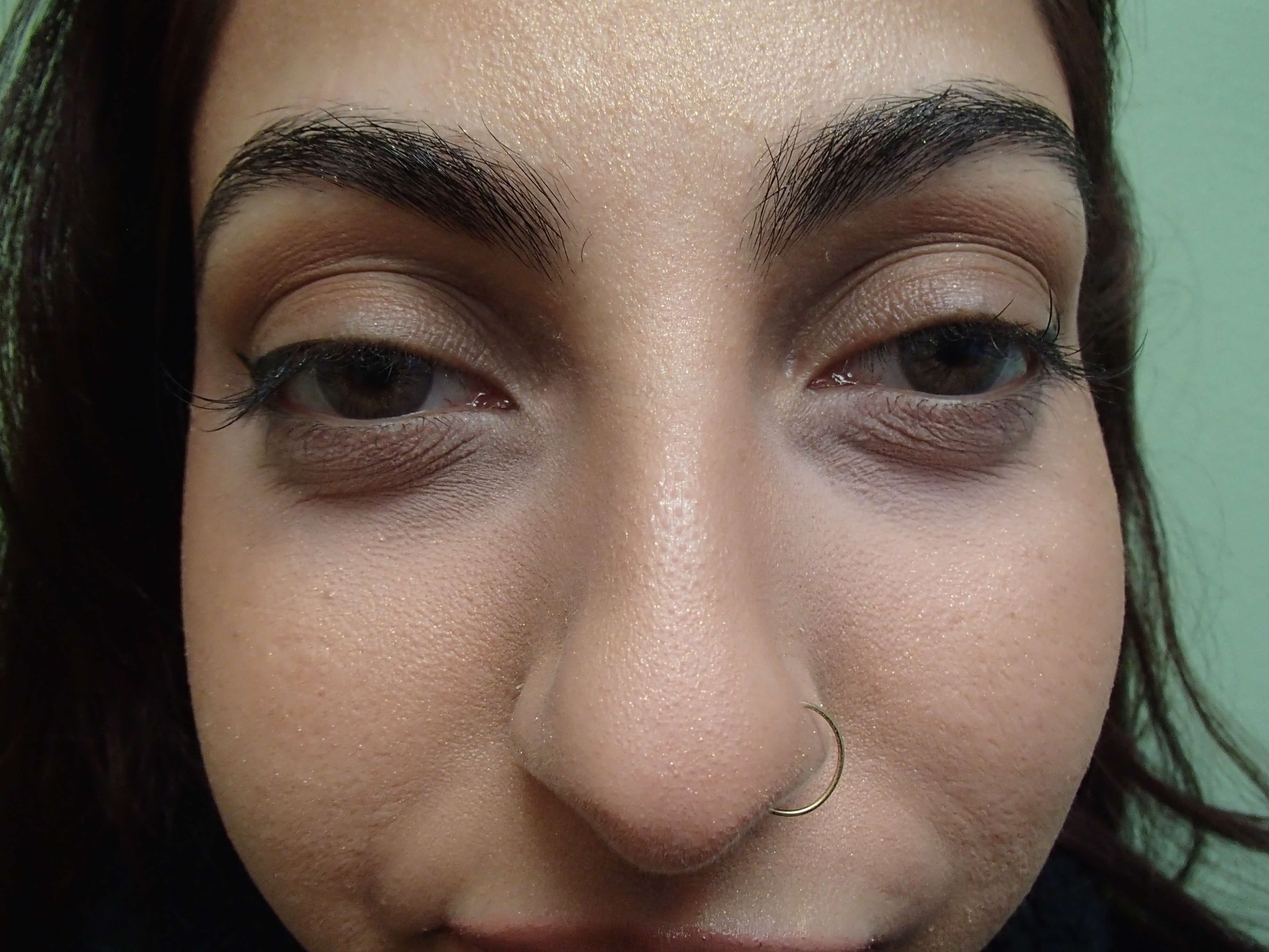 Rhinoplasty (Nose Job) Before