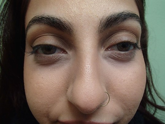 Rhinoplasty (Nose Job) Before