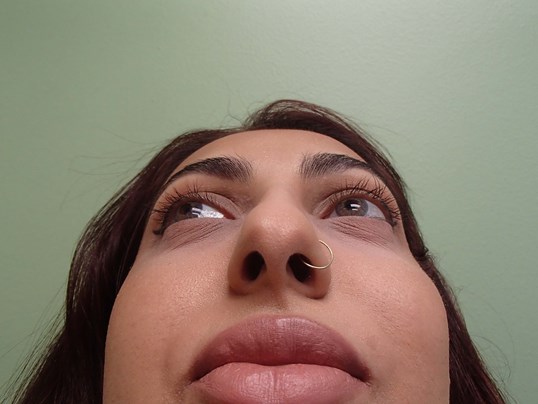 Rhinoplasty (Nose Job) Before