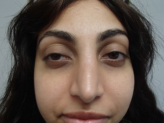 Rhinoplasty (Nose Job) After