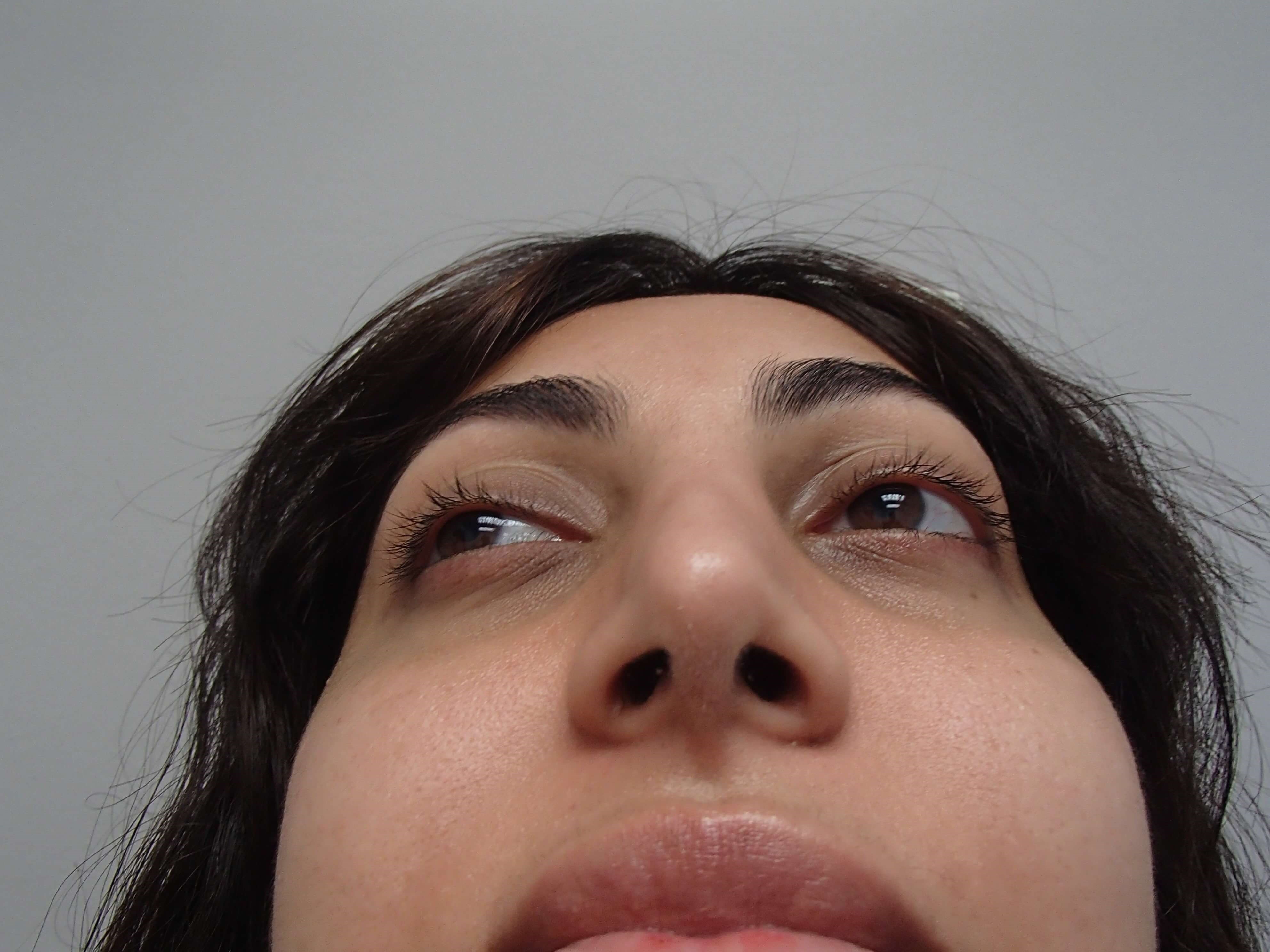 Rhinoplasty (Nose Job) After