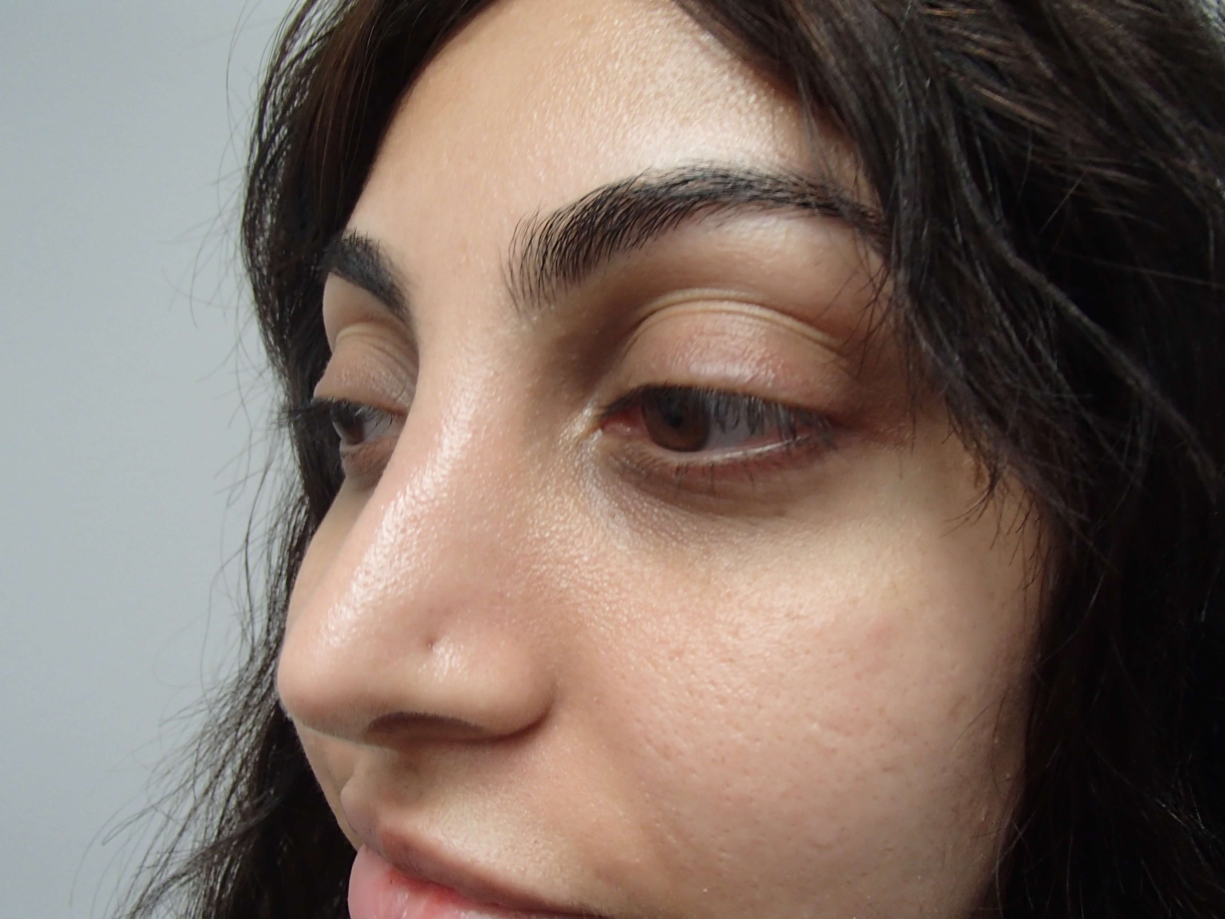 Rhinoplasty (Nose Job) After