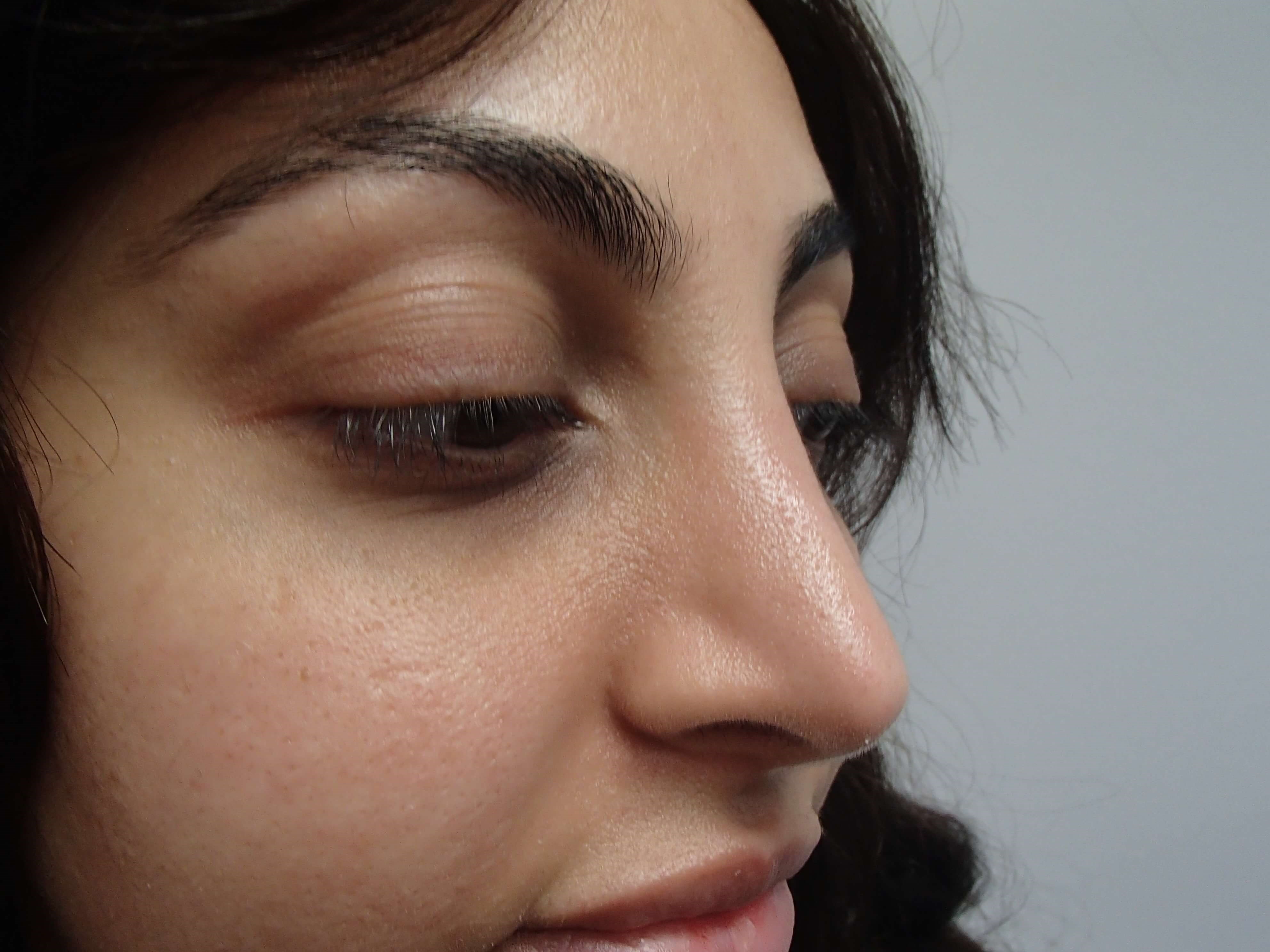 Rhinoplasty (Nose Job) After