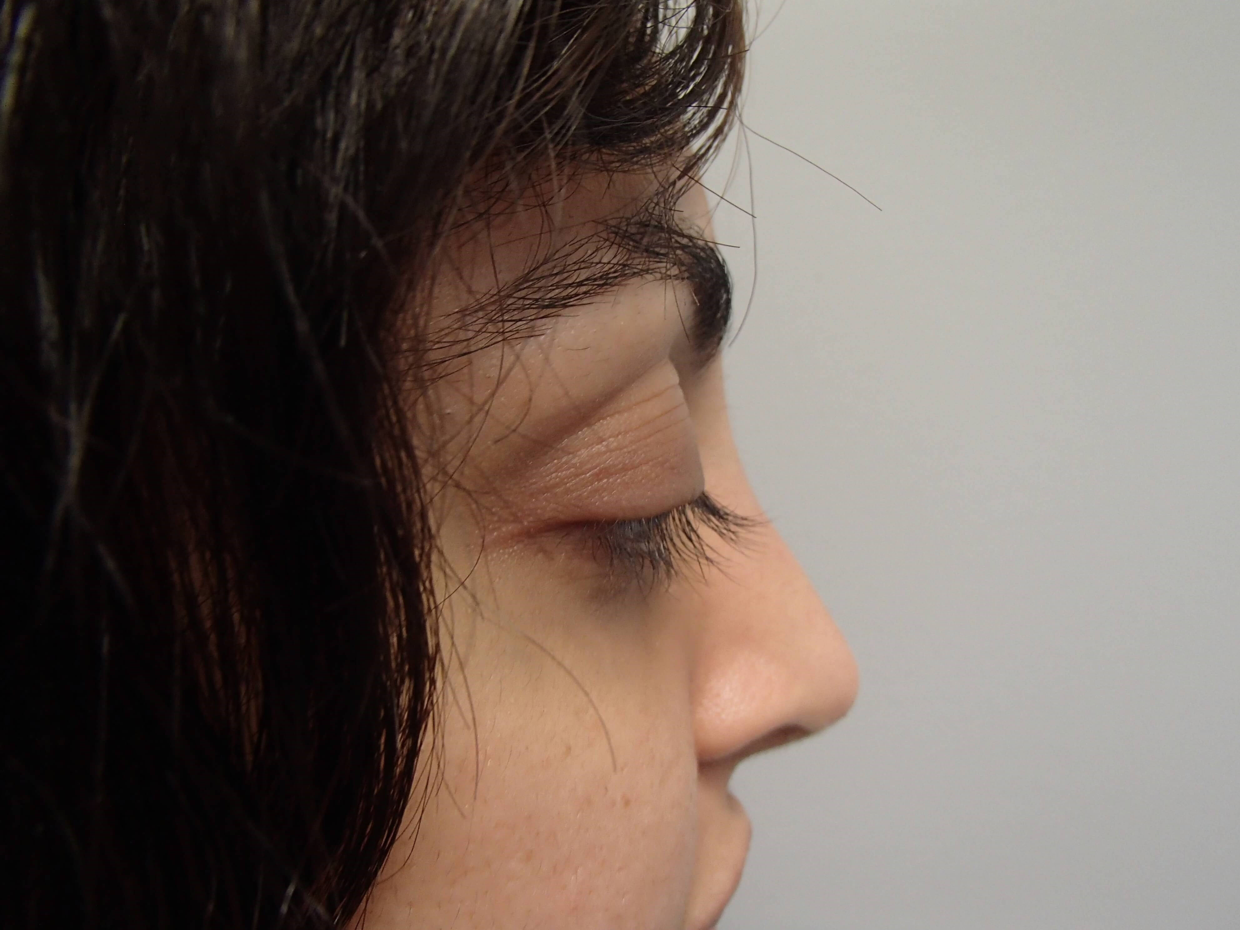 Rhinoplasty (Nose Job) After